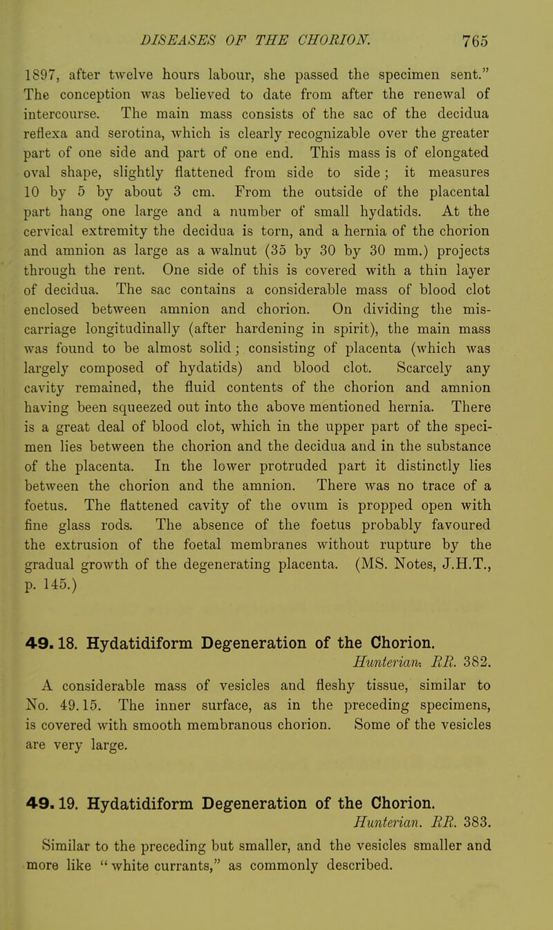 1897, after twelve hours labour, she passed the specimen sent. The conception was believed to date from after the renewal of intercourse. The main mass consists of the sac of the decidua reflexa and serotina, which is clearly recognizable over the greater part of one side and part of one end. This mass is of elongated oval shape, slightly flattened from side to side; it measures 10 by 5 by about 3 cm. From the outside of the placental part hang one large and a number of small hydatids. At the cervical extremity the decidua is torn, and a hernia of the chorion and amnion as large as a walnut (35 by 30 by 30 mm.) projects through the rent. One side of this is covered with a thin layer of decidua. The sac contains a considerable mass of blood clot enclosed between amnion and chorion. On dividing the mis- carriage longitudinally (after hardening in spirit), the main mass was found to be almost solid; consisting of placenta (which was largely composed of hydatids) and blood clot. Scarcely any cavity remained, the fluid contents of the chorion and amnion having been squeezed out into the above mentioned hernia. There is a great deal of blood clot, which in the upper part of the speci- men lies between the chorion and the decidua and in the substance of the placenta. In the lower protruded part it distinctly lies between the chorion and the amnion. There was no trace of a foetus. The flattened cavity of the ovum is propped open with fine glass rods. The absence of the foetus probably favoured the extrusion of the foetal membranes without rupture by the gradual growth of the degenerating placenta. (MS. Notes, J.H.T., p. 145.) 49.18. Hydatidiform Degeneration of the Chorion. Hunterian-. BE. 382. A considerable mass of vesicles and fleshy tissue, similar to No. 49.15. The inner surface, as in the jDreceding specimens, is covered with smooth membranous chorion. Some of the vesicles are very large. 49.19. Hydatidiform Degeneration of the Chorion. Hunterian. RR. 383. Similar to the preceding but smaller, and the vesicles smaller and more like  white currants, as commonly described.