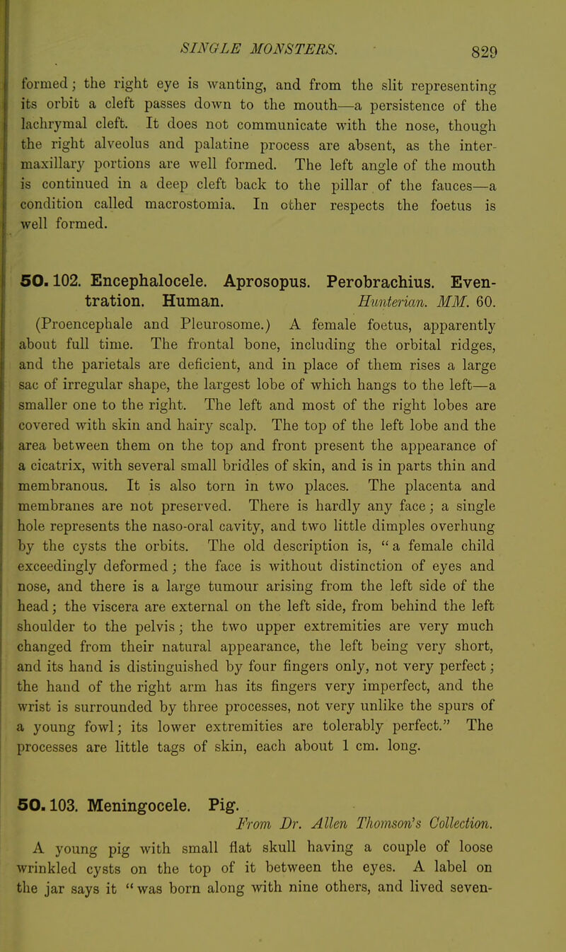 tbrmed; the right eye is wanting, and from the slit representing its orbit a cleft passes down to the mouth—a persistence of the lachrymal cleft. It does not communicate with the nose, though the right alveolus and palatine process are absent, as the inter- maxillary portions are well formed. The left angle of the mouth is continued in a deep cleft back to the pillar of the fauces—a condition called macrostomia. In other respects the foetus is well formed. 50.102. Encephalocele. Aprosopus. Perobrachius. Even- tration. Human. Eunterian. MM. 60. (Proencephale and Pieurosome.) A female foetus, apparently about full time. The frontal bone, including the orbital ridges, and the parietals are deficient, and in place of them rises a large sac of irregular shape, the largest lobe of which hangs to the left—a smaller one to the right. The left and most of the right lobes are covered with skin and hairy scalp. The top of the left lobe and the area between them on the top and front present the appearance of a cicatrix, with several small bridles of skin, and is in parts thin and membranous. It is also torn in two places. The placenta and membranes are not preserved. There is hardly any face; a single hole represents the naso-oral cavity, and two little dimples overhung by the cysts the orbits. The old description is,  a female child exceedingly deformed; the face is without distinction of eyes and nose, and there is a large tumour arising from the left side of the head; the viscera are external on the left side, from behind the left shoulder to the pelvis; the two upper extremities are very much changed from their natural appearance, the left being very short, and its hand is distinguished by four fingers only, not very perfect; the hand of the right arm has its fingers very imperfect, and the wrist is surrounded by three processes, not very unlike the spurs of a young fowl; its lower extremities are tolerably perfect. The processes are little tags of skin, each about 1 cm. long. 50.103. Meningocele. Pig. From Dr. Allen Thomson's Collection. A young pig with small flat skull having a couple of loose wrinkled cysts on the top of it between the eyes. A label on the jar says it  was born along with nine others, and lived seven-