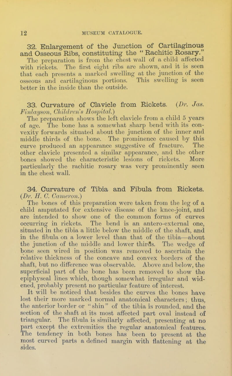 32. Enlargement of the Junction of Cartilaginous and Osseous Ribs, constituting the  Rachitic Rosary. The preparation is from the chest wall of a child affected with rickets. The first eight ribs are shown, and it is seen that each presents a marked swelling at the junction of the osseous and cartilaginous portions. This swelling is seen better in the inside than the outside. 33. Curvature of Clavicle from Rickets. (Br. Jas. Finlayson, CJiildrcns Hospital.) The preparation shows the left clavicle from a child 5 years of age. The bone has a somewhat sharp bend with its con- vexity forwards situated about the junction of the inner and middle thirds of the bone. The prominence caused by this curve produced an appearance suggestive of fracture. The other clavicle presented a similar appearance, and the other bones showed the characteristic lesions of rickets. More particularly the rachitic rosary was very prominently seen in the chest wall. 34. Curvature of Tibia and Fibula from Rickets. {Dr. H. C. Cameron.) The bones of this preparation were taken from the leg of a child amputated for extensive disease of the knee-joint, and are intended to show one of the connnon forms of curves occurring in rickets. The bend is an antero-external one, situated in the tibia a little below the middle of the shaft, and in the fibula on a lower level than that of the tibia^—about the junction of the middle and lower thirds. The wedge of bone seen wired in position was removed to ascertain the relative thickness of the concave and convex borders of the shaft, but no difference was observable. Above and below, the superficial part of the bone has been removed to show the epiphyseal lines which, though somewhat irregular and wid- ened, probably present no particular feature of interest. It will be noticed that besides the curves the bones have lost their more marked normal anatomical characters; thus, the anterior border or  shin  of the tibia is rounded, and the section of the shaft at its most affected part oval instead of triangular. The fibula is similarly affected, presenting at no part except the extremities the regular anatomical features. The tendency in both bones has been to present at the most curved parts a defined margin with flattening at the sides.