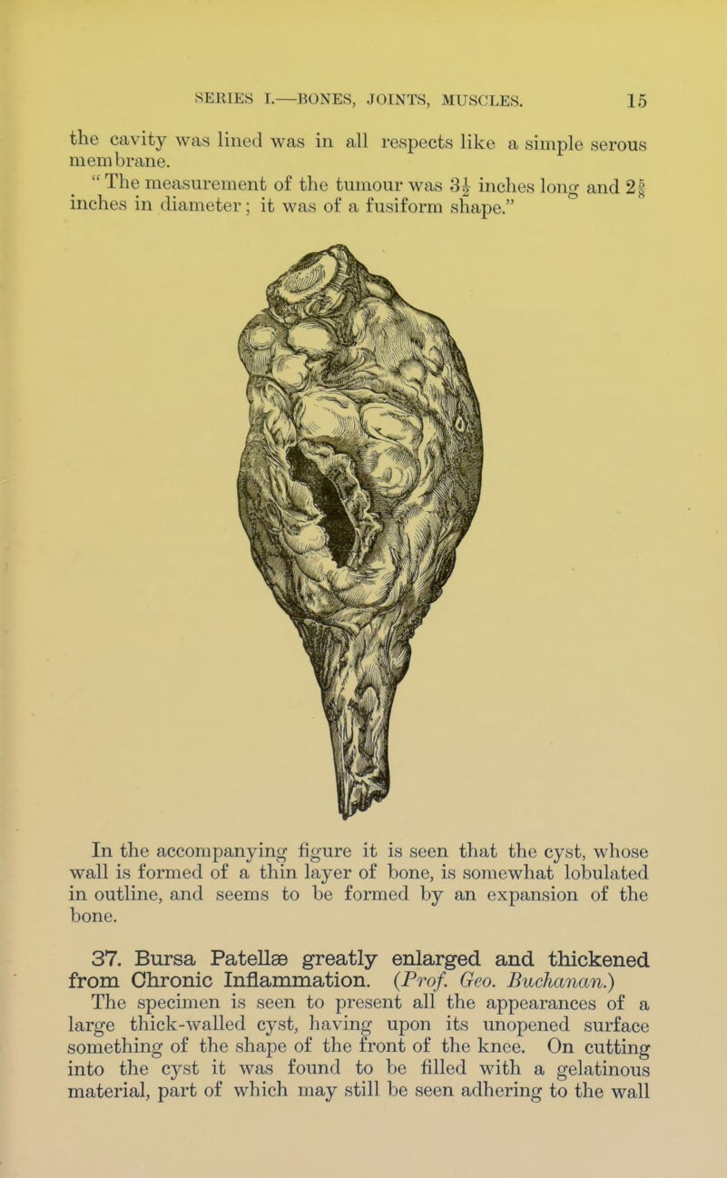 the cavity was lined was in all respects like a simple serous membrane.  The measurement of the tumour was 3^ inches long and 2| inches in diameter; it was of a fusiform shape. In the accompanying figure it is seen that the cyst, whose wall is formed of a thin layer of bone, is somewhat lobulated in outline, and seems to be formed by an expansion of the bone. 37. Bursa PatellaB greatly enlarged and thickened from Chronic Inflammation. {Prof. Geo. Buchanan.) The specimen is seen to present all the appearances of a large thick-walled cyst, having upon its unopened surface something of the shape of the front of the knee. On cutting into the cyst it was found to be filled with a gelatinous material, part of which may still be seen adhering to the wall