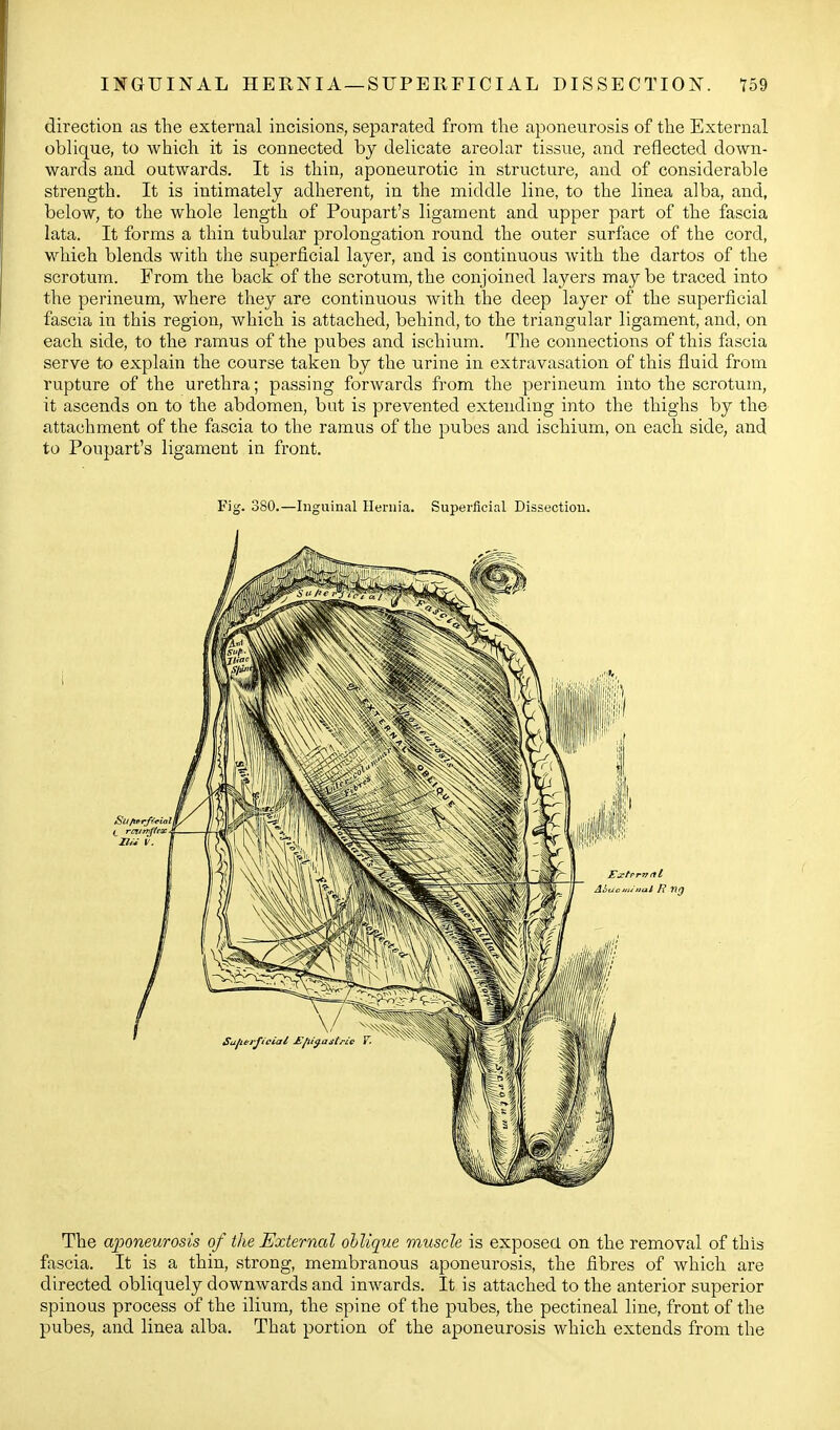 IT^GUINAL HERNIA- SUPERFICIAL DISSECTION. T59 direction as the external incisions, separated from tlie aponeurosis of the External oblique, to which it is connected by delicate areolar tissue, and reflected down- wards and outwards. It is thin, aponeurotic in structure, and of considerable strength. It is intimately adherent, in the middle line, to the linea alba, and, below, to the whole length of Poupart's ligament and upper part of the fascia lata. It forms a thin tubular prolongation round the outer surface of the cord, which blends with the superficial layer, and is continuous Avith the dartos of the scrotum. From the back of the scrotum, the conjoined layers may be traced into the perineum, where they are continuous with the deep layer of the superficial fascia in this region, which is attached, behind, to the triangular ligament, and, on each side, to the ramus of the pubes and ischium. The connections of this fascia serve to explain the course taken by the urine in extravasation of this fluid from rupture of the urethra; passing forwards from the perineum into the scrotum, it ascends on to the abdomen, but is prevented extending into the thighs by the attachment of the fascia to the ramus of the pubes and ischium, on each side, and to Poupart's ligament in front. Fig. 380.—Inguinal Hernia. Superficial Dissection. The aponeurosis of the External oblique muscle is exposed, on the removal of this fascia. It is a thin, strong, membranous aponeurosis, the fibres of which are directed obliquely downwards and inwards. It is attached to the anterior superior spinous process of the ilium, the spine of the pubes, the pectineal line, front of the pubes, and linea alba. That portion of the aponeurosis which extends from the