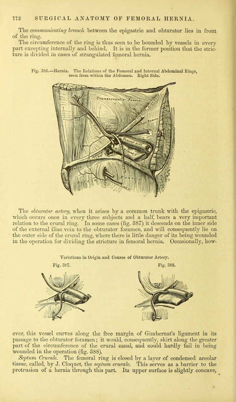 Tlie communicating branch between the epigastric and obturator lies in front of the ring. The circumference of the ring is thus seen to be bounded by vessels in every part excepting internally and behind. It is in the former position that the stric- ture is divided in cases of strangulated femoral hernia. Fig. 386.—Hernia. The Relations of the Femoral and Internal Abdominal Rings, seen from within the Abdomen. Eight Side. The oUurator arterTj, when it arises by a common trunk with the epigastric, which occurs once in every three subjects and a half, bears a very imjDortant relation to the crural ring. In some cases (fig. 387) it descends on the inner side of the external iliac vein to the obturator foramen, and will consequently lie on the outer side of the crural ring, where there is little danger of its being wounded in the operation for dividing the stricture in femoral hernia. Occasionally, how- Variations in Origin and Course of Obturator Artery. Fig. 387. Fig. 388. ever, this vessel curves along the free margin of Gimbernat's ligament in its passage to the obturator foramen; it would, consequently, skirt along the greater part of the circumference of the crural canal, and could hardly fail in being wounded in the operation (fig. 888). Septum Crurale. The femoral ring is closed by a layer of condensed areolar tissue, called, by J. Cloquet, the septum crurale. This serves as a barrier to the protrusion of a hernia through this part. Its upper surface is slightly concave,