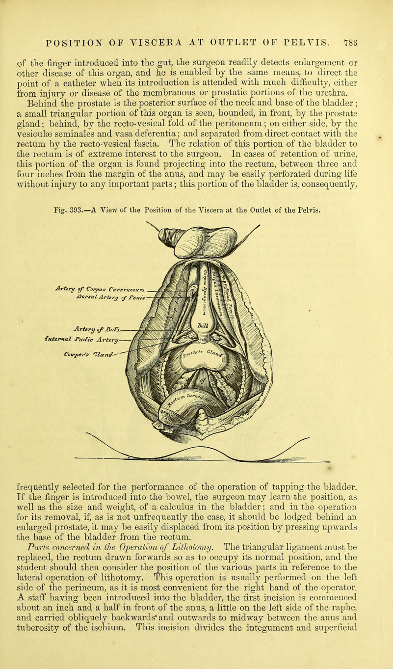 POSITION OF VISCERA AT OUTLET OF PELVIS. 183 of the finger introduced into the gut, the surgeon readily detects enlargement or other disease of this organ, and he is enabled by the same means, to direct the point of a catheter when its introduction is attended with much difficulty, either from injury or disease of the membranous or prostatic portions of the urethra. Behind the prostate is the posterior surface of the neck and base of the bladder; a small triangular portion of this organ is seen, bounded, in front, by the prostate gland; behind, by the recto-vesical fold of the peritoneum ; on either side, by the vesiculse seminales and vasa deferentia; and separated from direct contact with the rectum by the recto-vesical fascia. The relation of this portion of the bladder to the rectum is of extreme interest to the surgeon. In cases of retention of urine, this portion of the organ is found projecting into the rectum, between three and fou.r inches from the margin of the anus, and may be easily perforated during life without injury to any important parts; this portion of the bladder is, consequently, Fig. 393.—A View of the Position of the Viscera at the Outlet of the Pelvis. frequently selected for the performance of the operation of tapping the bladder. If the finger is introduced into the bowel, the surgeon may learn the position, as well as the size and weight, of a calculus in the bladder; and in the operation for its removal, if, as is not unfrequently the case, it should be lodged behind an enlarged prostate, it may be easily displaced from its position by pressing upwards the base of the bladder from the rectum. Parts concerned in the Operation of Lithotomy. The triangular ligament must be replaced, the rectum drawn forwards so as to occupy its normal position, and the student should then consider the position of the various parts in reference to the lateral operation of lithotomy. This operation is usually performed on the left side of the perineum, as it is most convenient for the right hand of the operator. A staff having been introduced into the bladder, the first incision is commenced about an inch and a hall in front of the anus, a little on the left side of the raphe, and carried obliquely backwards' and outwards to midway between the anus and tuberosity of the ischium. This incision divides the integument and superficial