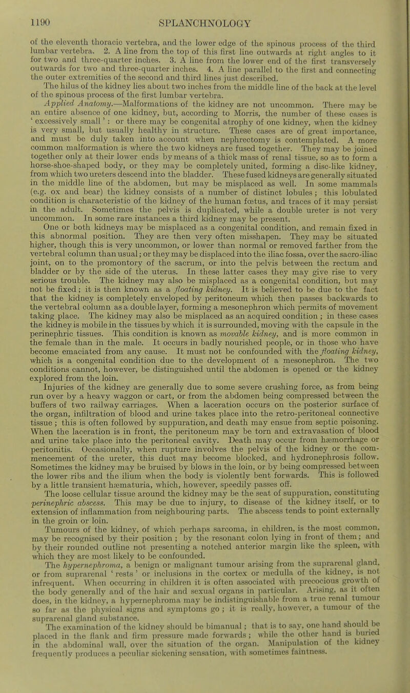 of the eleventh thoracic vertebra, and the lower edge of the spinous process of the third lumbar vertebra. 2. A line from the top of this first lino outwards at right angles to it for two and three-quarter inches. 3. A line from the lower end of the first transversely outwards for two and three-quarter inches. 4. A line parallel to the first and connecting the outer extremities of the second and third lines just described. The hilus of the kidney lies about two inches from the middle line of the back at the level of the spinous process of the fii-st lumbar vertebra. Applied Anatomy.—Malforjnations of the kidney are not uncommon. Tiiere may be an entire absence of one kidney, but, according to Morris, the number of these cases is ' excessively small' : or there may bo congenital atrophy of one kidney, when the kidney is very small, but usually healthy in structure. These cases are of great importance, and must bo duly taken into account when nephrectomy is contemplated. A more common malformation is where the two kidneys are fused together. Tliey may be joined together only at their lower ends by means of a thick mass of renal tissue, so as to form a horse-shoe-shaped body, or tliey may be completely united, forming a disc-like kidney, from which two m-eters descend into the bladder. These fused kidneys are generally situated in the middle line of the abdomen, but may be misplaced as well. In some mammals (e.g. ox and bear) the kidney consists of a number of distinct lobules ; this lobulated condition is characteristic of the kidney of the human foetus, and traces of it may persist in the adult. Sometimes the pehds is duplicated, while a double ureter is not ver}' uncommon. In some rare instances a third kidney may be present. One or both kidneys may be misplaced as a congenital condition, and remain fixed in this abnormal position. They are then very often misshapen. They may be situated higher, though this is very uncommon, or lower than normal or removed farther from the vertebral column than usual; or they may be displaced into the ihac fossa, over the sacro-diac joint, on to the promontory of the sacrum, or into the pelvis between the rectum and bladder or by the side of the uterus. In these latter cases they maj' give rise to very serious trouble. The kidney may also be misplaced as a congenital condition, but may not be fixed; it is then known as a floating kidney. It is believed to be due to the fact that the kidney is completely enveloped by j)eritoneum which then passes backwards to the vertebral column as a double layer, forming a mesonephron which permits of movement taking place. The kidney may also be misplaced as an acquired condition ; in these cases the kidney is mobile in the tissues by which it is surrounded, moving vfith the capsule in the perinephric tissues. This condition is known as movable kidney, and is more common in the female than in the male. It occurs in badly nom-ished people, or in those who have become emaciated from any cause. It must not be confounded with the floating kidney, which is a congenital condition due to the development of a mesonephron. The two conditions cannot, however, be distinguished until the abdomen is opened or the kidney explored from the loin. Injuries of the kidney are generally due to some severe crushing force, as from being run over by a heavy waggon or cart, or from the abdomen being compressed between the buffers of two railway carriages. When a laceration occurs on the posterior surface of the organ, infiltration of blood and m-ine takes place into the retro-peritoneal coimective tissue ; this is often followed by suppuration, and death may ensue from septic poisoning. When the laceration is in front, the peritoneum may be torn and extravasation of blood and urine take place into the peritoneal cavity. Death may occur from hsemorrhage or peritonitis. Occasionally, when rupture involves the pelvis of the kidney or the com- mencement of the ureter, this duct may become blocked, and hydronephrosis follow. Sometimes the kidney may be bruised by blows in the loin, or by being compressed between the lower ribs and the ilium when the body is violently bent forwards. This is followed by a little transient haimaturia, which, however, speedily passes off. The loose cellular tissue around the kidney may be the seat of suppuration, constituting perinephric abscess. This may be due to injury, to disease of the kidney itself, or to extension of inflammation from neighboui-ing parts. The abscess tends to point externally in the groin or loin. Timiours of the kidney, of which perhaps sarcoma, in children, is the most common, may be recognised by their position ; by the resonant colon lying in front of them; and by their rounded outline not presenting a notched anterior margin like the spleen, with which they are most likely to be confounded. The hypernephroma, a benign or malignant tumour arising from the suprarenal gland, or from suprarenal ' rests ' or inclusions in the cortex or medulla of the kidney, is not infrequent. When occurring in cluldren it is often associated with ])recocious growth of the body generally and of the hair and sexual organs in particular. Arising, as it often does, in the kidney, a hyi)ernephroma may be indistinguishable from a true renal tumour so far as the physical signs and symptoms go ; it is really, however, a tiunour of the suprarenal gland substance. ITie examination of the kidnev should be bimanual; that is to say, one hand should be placed in the flank and lirm ]iressure made forwards ; while the other hand is buried in the abdominal wall, over the situation of the organ. Manipulation of the kidney frequently produces a peculiar sickening sensation, with sometimes faintness.