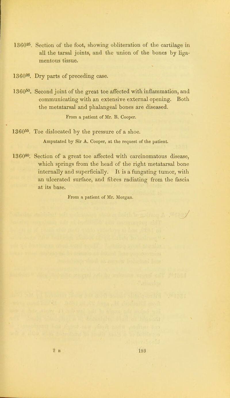 ISSO'**. Section of the foot, showing obliteration of the cartilage in all the tarsal joints, and the union of the bones by liga- mentous tissue. 136026. Dry parts of preceding case. 1360^. Second joint of the great toe affected with inflammation, and communicating with an extensive external opening. Both the metatarsal and phalangeal bones are diseased. From a patient of Mr. B. Cooper. 1360^. Toe dislocated by the pressure of a shoe. Amputated by Sir A. Cooper, at the request of the patient. 1360®'. Section of a great toe affected with carcinomatous disease, which springs from the head of the right metatarsal bone internally and superficially. It is a fangatiug tumor, with an ulcerated surface, and fibres radiating from the fascia at its base. From a patient of Mr. Morgan.