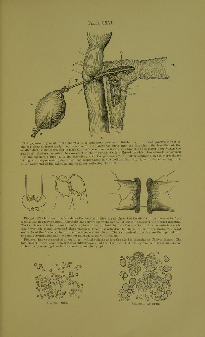 Fin. 317.—Arrangement of the cannula in a temporary pancreatic fistula. A, the chief pancreatic duct of the (log directed trausrersely ; a, insertion of the pancreatic ducts into the intestine; the insertion of the smaller duct is higher up, and is marked by a line without a letter; a', a hr.mch of the larger duct within the gland; a, lig.-vture, fastening the cannula T to the hitestine;//, is a thread by which the cannula is fastened into the pancreatic duct; I, is the intestine; P P', the pancreas ; T, the silver cannula; K, the stopcock, for lettuig out the pancreatic juice which has accumulated in the india-rubber bag; V, an india-rubber hag, tied to the outer end of the cannula, and used for collecting the juice. Flo. 318.—The left-hand diagram shows the method of stitching up the end of the divided intestine so as to foi-m a cul-de-tac in Thlry's fistula. The right hand figure shows the method of stitching together the divided intestine. The two black dots in the middle of the pieces already joined, indicate the position of the mesenteric vessels. The first stitch should surround these vessels and seri e as a ligature for them. Five or six similar stitches at each side of the first serve to join the one edge, as shown here. The two ends of intestine are then pulled into the same straight line and the junction finished, as shown in fic. 319. FIG. 319.—Shows the method of applying the final stitches to join the divided intestine in Tbiry's fistula. The two ends of intestine are represented as entirely ajiart, but the other half of the circumference must be understood to l>e already sewn together in the manner shown in fig, 318. O 0, a , 00 PIO. 3ao.-Mllk. Pifl, 321.—Uolontrum.