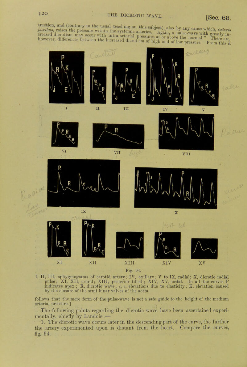 THE DICROTIC WAVE. [Sec. 68. traction, and (contrary to the usual teaching on this siihiPf>« oi™ i„ paribus, raises the pressure within the systemic a!Km, t k cause w,lllch> ccOeris creased diorotism n!av occur with £52233 p.essu 'es atoiWrffrlS! ^ ^ however, diilerences between the increased dicroShign anfoTfow 1 3 v si 1 e 1 Fig. 94. I, II, III, sphygmograms of carotid arteiy; IV, axillary; V to IX, radial; X, dicrotic radial pulse; XI, XII, crural; XIII, posterior tibial; XIV, XV, pedal. In all the curves P indicates apex ; R, dicrotic wave; e, e, elevations due to elasticity; K, elevation caused by the closure of the semi-lunar valves of the aorta. follows that the mere form of the pulse-wave is not a safe guide to the height of the medium arterial pressure.] The following points regarding the dicrotic wave have been ascertained experi- mentally, chiefly by Landois :— 1. The dicrotic wave occurs later in the descending part of the curve, the further the artery experimented upon is distant from the heart. Compare (he curves, fig. 94.