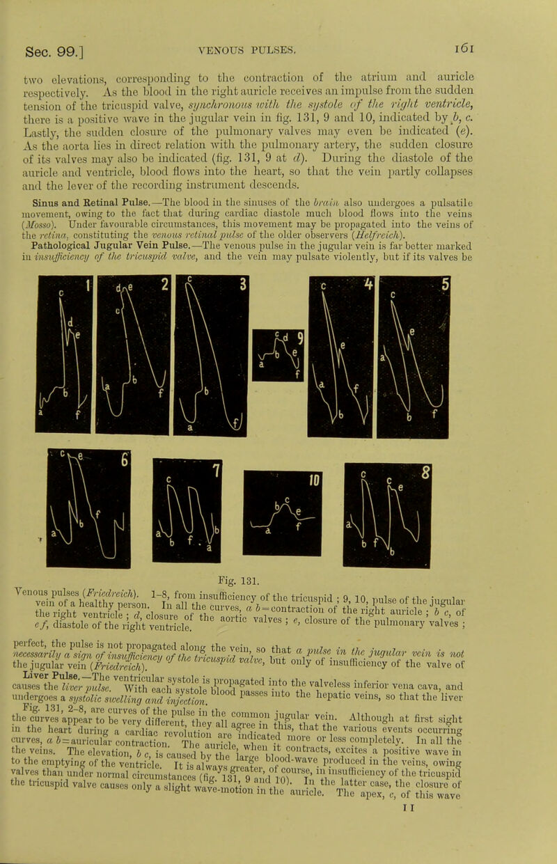 two elevations, corresponding to the contraction of the atrium and auricle respectively. As the blood in the right auricle receives an impulse from the sudden tension of the tricuspid valve, synchronoics toitli the systole of the right ventricle, there is a positive wave in the jugular vein in lig. 131, 9 and 10, indicated by b, c. Lastly, the sudden closure of the pulmonary valves may even be indicated (e). As the aorta lies in direct relation with the pulmonary artery, the sudden closure of its valves may also be indicated (fig. 131, 9 at d). During the diastole of the auricle and ventricle, blood flows into the heart, so that the vein partly collapses and the lever of the recording instrument descends. Sinus and Retinal Pulse.—The blood in the sinuses of the brain also undergoes a pulsatile movement, owing to the fact that during cardiac diastole much blood flows into the veins (Mosso). Under favourable circumstances, this movement may be propagated into the veins of the retina, constituting the venous retinal pulse of the older observers (Hclfrcich). Pathological Jugular Vein Pulse.—The venous pulse in the jugular vein is far better marked in insufficiency of the tricuspid valve, and the vein may pulsate violently, but if its valves be c e 8 Fig. 131. YenZr^iSmSon 11;/Xf,hinSllfficienCy;°f the tlic^id ; 9' 10' P^eof the jugular ca£X^ ¥» % -Iveless inferior vena cava, and undergoes a syskic i*EJ«5ftgSt ^ mt° h^atiC VehlS' 80 that the the egurve3s'ap2pearato S^IS^fiJ^ ™°n J* MtU^h at filst in the heart during SSiZi^'M1'8' that the Various eraits occurring curves, a b = auricular o« lS ,^ 'm°re 0r less completely. In all the the veins. The elevat io„, TcauSbv no i J '1/ J***0* CfUes a >)0sitive wave »' to the emptying of the ventricle T L alLvl ^ f bl?od-wave. produced in the veins, owing valves than under nomalS^ton<^SW K ,° ™™?®™™y of the tricuspid tricuspid valve causes only a I I