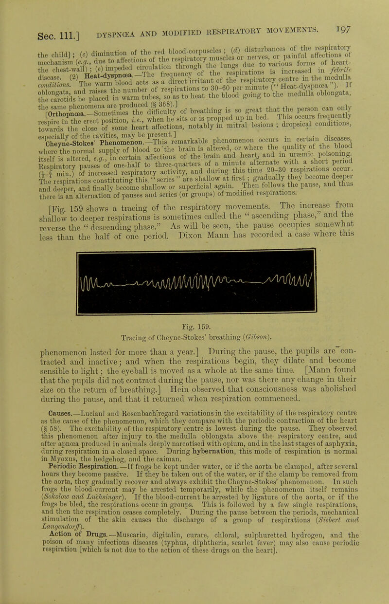 the child]; W diminution f^jt^^^^^T^S^^ disease. <%*e»™^JS ac^ M a direct irritant of the respiratory centre in the medulla 3ds tS close of some heart affections, notably in mitral lesions ; dropsical conditions, «!?£SXi-le phenomenon occurs in where the normal supply of blood to the brain is altered, or where the quality of the blood t elf if altered fl ^fn certain affections of the brain and heart, and in uramnc poisoning 1 esDiratorv pausesof one-half to three-quarters of a minute alternate with a short period tf m n [ oT ncrea eS respiratory activity, and daring this time 20-30 respirations occur TlwrSS rations constituting this. « series » are shallow at first ; gradually they become deeper and deeper, and finally become shallow or superficial again. Then follows the pause, and thus there is an alternation of pauses and series (or groups) of modified respirations. [Fig. 159 shows a tracing of the respiratory movements. The increase from shallow to deeper respirations is sometimes called the  ascending phase, and the reverse the  descending phase. As will he seen, the pause occupies somewhat less than the half of one period. Dixon Mann has recorded a case where this Fig. 159. Tracing of Cheyne-Stokes' breathing (Gibson). phenomenon lasted for more than a year.] During the pause, the pupils are con- tracted and inactive; and when the respirations hegin, they dilate and hecome sensible to light; the eyeball is moved as a whole at the same time. [Mann found that the pupils did not contract during the pause, nor was there any change in their size on the return of breathing.] Hein observed that consciousness wras abolished during the pause, and that it returned when respiration commenced. Causes.—Luciani and Rosenbaclr'regard variations in the excitability of the respiratory centre as the cause of the phenomenon, which they compare with the periodic contraction of the heart (§ 58). The excitability of the respiratory centre is lowest during the pause. They observed this phenomenon after injury to the medulla oblongata above the respiratory centre, and after apncea produced in animals deeply narcotised with opium, and in the last stages of asphyxia, during respiration in a closed space. During hybernation, this mode of respiration is normal in Myoxus, the hedgehog, and the caiman. Periodic Respiration.—If frogs be kept under water, or if the aorta be clamped, after several hours they become passive. If they be taken out of the water, or if the clamp be removed from the aorta, they gradually recover and always exhibit the Cheyne-Stokes' phenomenon. In such frogs the blood-current may be arrested temporarily, while the phenomenon itself remains (Sokolow and Litclisinger). If the blood-current be arrested by ligature of the aorta, or if the frogs be bled, the respirations occur in groups. This is followed by a few single respirations, and then the respiration ceases completely. During the pause between the periods, mechanical stimulation of the skin causes the discharge of a group of respirations (Sicbert and Langendorff). Action of Drugs.—Muscarin, digitalin, curare, chloral, sulphuretted hydrogen, and the poison of many infectious diseases (typhus, diphtheria, scarlet fever) may also cause periodic respiration [which is not duo to the action of these drugs on the heart].