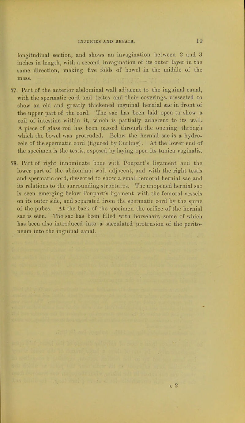 longitudinal section, and shows an invagination between 2 and 3 inches in length, with a second invagination of its outer layer in the same direction, making five folds of bowel in the middle of the mass. 77. Part of the anterior abdominal wall adjacent to the inguinal canal, with the spermatic cord and testes and their coverings, dissected to show an old and greatly thickened inguinal hernial sac in front of the upper part of the cord. The sac has been laid open to show a coil of intestine within it, which is partially adherent to its wall. A piece of glass rod has been passed through the opening through which the bowel was protruded. Below the hernial sac is a hydro- cele of the spermatic cord (figured by Curling). At the lower end of the specimen is the testis, exposed by laying open its tunica vaginalis. 78. Part of right innominate bone with Poupart's ligament and the lower part of the abdominal wall adjacent, and with the right testis and spermatic cord, dissected to show a small femoral hernial sac and its relations to the surrounding structures. The unopened hernial sac is seen emerging below Poupart''s ligament with the femoral vessels on its outer side, and separated from the spermatic cord by the spine of the pubes. At the back of the specimen the orifice of the hernial sac is se6n. The sac has been filled with horsehair, some of which has been also introduced into a sacculated protrusion of the perito- neum into the inguinal canal. V 2