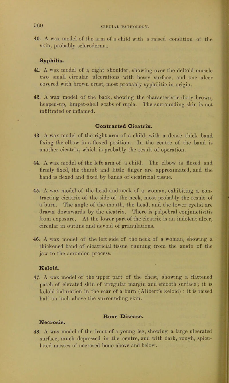 40. A wax model of the arm of a child with a raised condition of tlie skin, probably scleroderma. Syphilis. 41. A wax model of a right shoulder^ showing over the deltoid muscle two small circular ulcerations with bossy surface, and one ulcer covered with brow^n crust, most probably syphilitic in origin. 42. A wax model of the back, showing the characteristic dirty-brown, heaped-up, limpet-shell scabs of rupia. The surrounding skin is not infiltrated or inflamed. Contracted Cicatrix. 43. A wax model of the right arm of a child, with a dense thick band fixing the elbow in a flexed position. In the centre of the band is another cicatrix, which is probably the result of operation. 44. A wax model of the left arm of a child. The elbow is flexed and firmly fixed, the thumb and little finger are approximated, and the hand is flexed and fixed by bands of cicatricial tissue. 45. A wax model of the head and neck of a woman, exhibiting a con- tracting cicatrix of the side of the neck, most probably the result of a burn. The angle of the mouth, the head, and the lower eyelid are drawn downwards by the cicatrix. There is palpebral conjunctivitis from exposure. At the lower part of the cicatrix is an indolent ulcer, circular in outline and devoid of granulations. 46. A wax model of the left side of the neck of a woman, showing a thickened band of cicatricial tissue running from the angle of the jaw to the acromion process. Keloid. 47. A wax model of the upper part of the chest, showing a flattened patch of elevated skin of irregular margin and smooth surface; it is keloid induration in the scar of a burn (Alibert's keloid) : it is raised half an inch above the surrounding skin. Bone Disease. Necrosis. 48. A wax model of the front of a young leg, showing a large ulcerated surface, much depressed in the centre, and with dark, rough, spicu- lated masses of necrosed bone above and below.