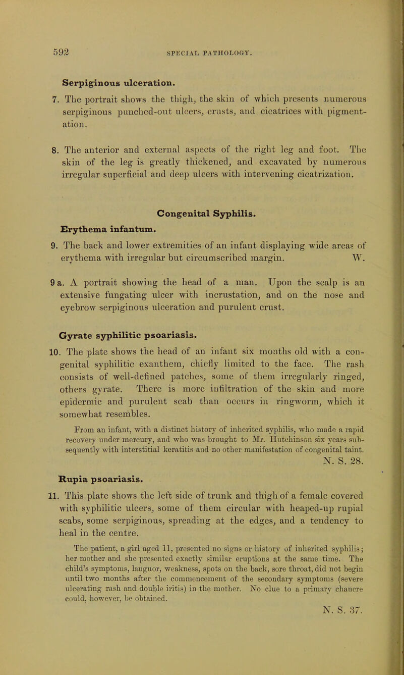 Serpiginous ulceration. 7. TLe portrait shows the thigh^ the skiu of which presents numerous sei'piginous punched-out ulcers, crusts, and cicatrices with pigment- ation . 8. The anterior and external aspects of the right leg and foot. The skin of the leg is greatly thickened, and excavated by numerous irregular superficial and deep ulcers with intervening cicatrization. Congenital Syphilis. Erythema infantum. 9. The back and lower extremities of an infant displaying wide areas of erythema with irregular but circumscribed margin. W. 9 a. A portrait showing the head of a man. Upon the scalp is an extensive fungating ulcer with incrustation, and on the nose and eyebrow serpiginous ulceration and purulent crust. Gyrate syphilitic psoariasis. 10. The plate shows the head of an infant six months old with a con- genital syphilitic exauthera, chiefly limited to the face. The rash consists of well-defined patches, some of them irregularly ringed, others gyrate. There is more infiltration of the skin and more epidermic and purulent scab than occurs in ringworm, which it somewhat reserhbles. From an infant, with a distinct history of inherited syphilis, who made a rapid recovery under mercury, and who was brought to Mr. Hutchinson six years sub- sequently with interstitial keratitis and no other manifestation of congenital taint. N. S. 28. Rupia psoariasis. 11. This plate shows the left side of trunk and thigh of a female covered with syphilitic ulcers, some of them circular with heaped-up rupial scabs, some serpiginous, spreading at the edges, and a tendency to heal in the centre. The patient, a girl aged 11, presented no signs or history of inherited syphilis; her mother and she presented exactly similar eruptions at the same time. The child's symptoms, languor, weakness, spots on the back, sore throat, did not begin imtil two months after the commencenjent of the secondary symptoms (severe ulcerating rash and double iritis) in the mother. No clue to a primary chanori! could, however, be obtained. N. S. 37.