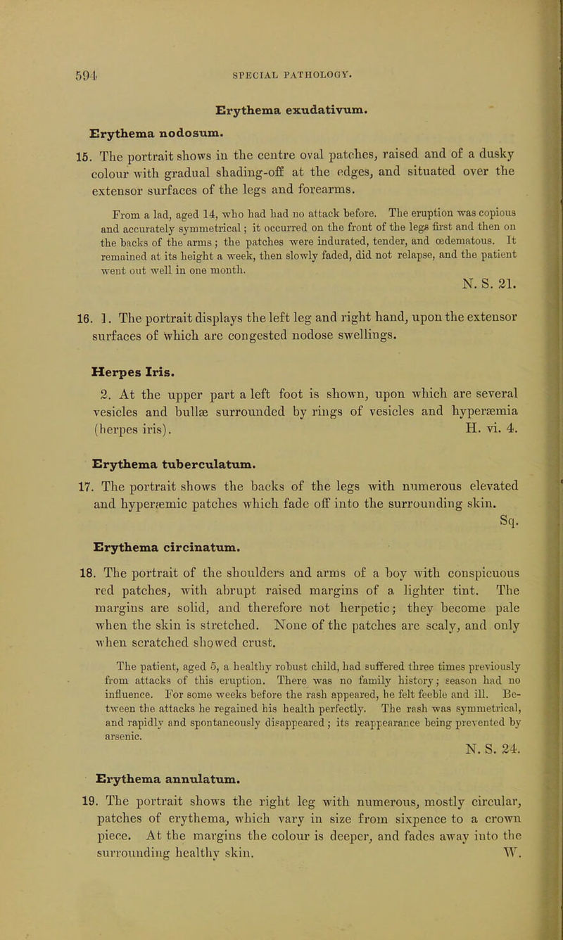 Erythema exudativum. Erythema nodosum. 16. The portrait shows in the centre oval patches, raised and of a dusky colour with gradual shading-off at the edges, and situated over the extensor surfaces of the legs and forearms. From a lad, aged 14, wlio liad bad no attack before. The eruption was copious and accurately symmetrical; it occurred on tbo front of tbe legs first and tben on tbe backs of tbe arms ; tbe patcbes were indurated, tender, and oedematous. It remained at its beigbt a week, tben slowly faded, did not relapse, and tbe patient went out well in one montb. N. S. 21. 16. ]. The portrait displays the left leg and right hand, upon the extensor surfaces of which are congested nodose swellings. Herpes Iris. 2. At the upper part a left foot is shown, upon which are several vesicles and bullge surrounded by rings of vesicles and hypersemia (herpes iris). H. vi. 4. Erythema tuberculatum. 17. The portrait shows the backs of the legs with numerous elevated and hyperfcmic patches which fade off into the surrounding skin. Sq. Erythema circinatum. 18. The portrait of the shoulders and arras of a boy with conspicuous red patches, with abrupt raised margins of a lighter tint. The margins are solid, and therefore not herpetic; they become pale when the skin is stretched. None of the patches are scaly, and only when scratched showed crust. Tbe patient, aged 5, a bealtby robust cbild, bad suffered tbree times previously from attacks of tbis eruption. Tbere was no family bistory; season bad no influence. For some weeks before tbe rasb appeared, be felt feeble and ill. Be- tween tbe attacks be regained bis healtb perfectly. Tbe rasb was symmetrical, and rapidly and spontaneously disappeared ; its reappearance being prevented by arsenic. N. S. 24. Erythema annulatum. 19. The portrait shows the right leg with numerous, mostly circular, patches of erythema, which vary in size from sixpence to a crown piece. At the margins the colour is deeper, and fades away into the surrounding healthy skin. W.
