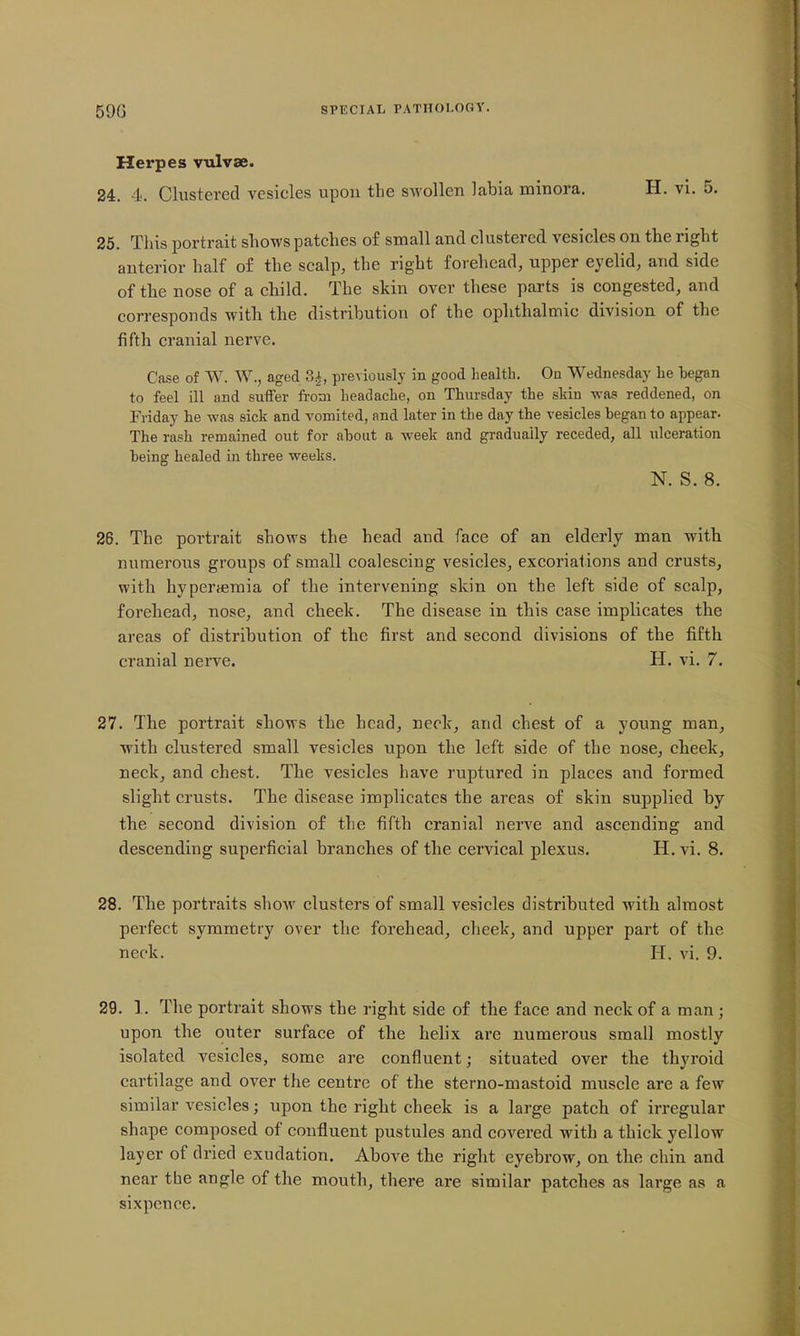 59G Herpes vulvae. 24. 4. Clustered vesicles upon the swollen labia minora. H. vi. 5. 25. This portrait shows patches of small and clustered vesicles on the right anterior half of the scalp, the right forehead, upper eyelid, and side of the nose of a child. The skin over these parts is congested, and corresponds with the distribution of the ophthalmic division of the fifth cranial nerve. Case of W. W., aged 3^, previously in good health. On Wednesday he began to feel ill and suffer from headache, on Thursday the skin was reddened, on Friday he was sick and A^omited, and later in the day the vesicles began to appear. The rash remained out for about a week and gradually receded, all ulceration being healed in three weeks. N. S. 8. 26. The poi'trait shows the head and face of an elderly man with numerous groups of small coalescing vesicles, excoriations and crusts, with hyperaeraia of the intervening skin on the left side of scalp, forehead, nose, and cheek. The disease in this case implicates the areas of distribution of the first and second divisions of the fifth cranial nerve. H. vi. 7. 27. The portrait shows the head, neck, and chest of a young man, with clustered small vesicles upon the left side of the nose, cheek, neck, and chest. The vesicles have ruptured in places and formed slight crusts. The disease implicates the areas of skin supplied by the second division of the fifth cranial nerve and ascending and descending superficial branches of the cervical plexus. H. vi. 8. 28. The portraits show clusters of small vesicles distributed with almost perfect symmetry over the forehead, cheek, and upper part of the neck. H. vi. 9. 29. 1. The portrait shows the right side of the face and neck of a man ; upon the outer surface of the helix are numerous small mostly isolated vesicles, some are confluent; situated over the thyroid cartilage and over the centre of the sterno-mastoid muscle are a few similar vesicles; upon the right cheek is a large patch of irregular shape composed of confluent pustules and covered with a thick yellow layer of dried exudation. Above the right eyebrow, on the chin and near the angle of the mouth, there are similar patches as large as a sixpence.