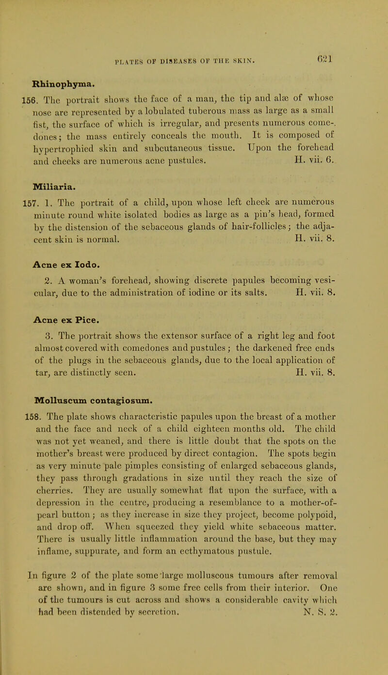 G:>1 Rhinophyma. 156. The portrait shows the face of a man, the tip and alse of whose nose are represented by alobulated tuberous mass as large as a small fist, the surface of which is irregular, and presents numerous come-, dones; the mass entirely conceals the mouth. It is composed of hypertrophied skin and subcutaneous tissue. Upon the forehead and checks are numerous acne pustules. H. vii. 6. Miliaria. 157. 1. The portrait of a child, upon whose left cheek are numerous minute round white isolated bodies as large as a pin's liead, formed by the distension of the sebaceous glands of hair-follicles; the adja- cent skin is normal. H. vii. 8. Acne ex lodo. 2. A woman's forehead, showing discrete papules becoming vesi- cular, due to the administration of iodine or its salts. H. vii. 8. Acne ex Pice. 3. The portrait shows the extensor surface of a right leg and foot almost covered with comedones and pustules; the darkened free ends of the plugs in the sebaceous glands, due to the local application of tar, are distinctly seen. H. vii. 8. Mollnscum contagiosum. 158. The plate shows characteristic papules upon the breast of a mother and the face and neck of a child eighteen months old. The child was not yet weaned, and there is little doubt that the spots on tlie mother's breast were produced by direct contagion. The spots begin as very minute pale pimples consisting of enlarged sebaceous glands, they pass through gradations in size until they reach the size of cherries. They are usually somewhat flat upon the surface, Avith a depression in the centre, producing a resemblance to a mother-of- pearl button; as they increase in size they project, become polypoid, and drop off. When squeezed they yield white sebaceous matter. There is usually little inflammation around the base, but they may inflame, suppurate, and form an ecthymatous pustule. In figure 2 of the plate some'large molluscous tumours after removal are shown, and in figure 3 some free cells from their interior. One of the tumours is cut across and shows a considerable cavity which had been distended by secretion. N. S. 2.