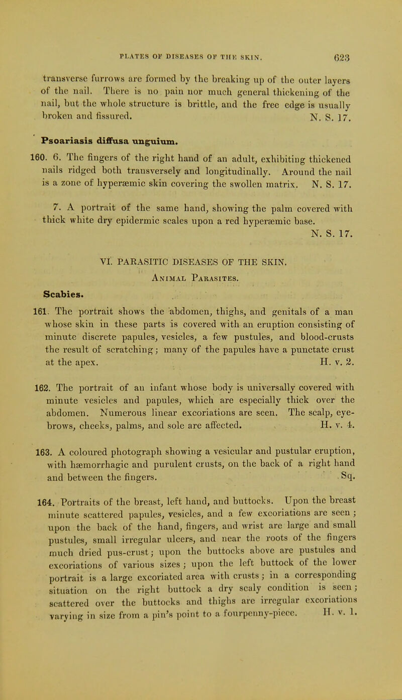 transverse furrows are formed by the breaking up of the outer layers of the nail. There is no pain nor much general thickening of the nail, but the whole structure is brittle, and the free edge is usually broken and fissured. N. S. 17. Psoariasis diffusa unguium. 160. 6. The fingers of the right hand of an adult, exhibiting thickened nails ridged both transversely and longitudinally. Around the nail is a zone of hypersemic skin covering the swollen matrix. N. S. 17. 7. A portrait of the same hand, showing the palm covered with thick white dry epidermic scales upon a red hyperaemic base. N. S. 17. VI. PARASITIC DISEASES OF THE SKIN. Animal Parasites. Scabies. 161. The portrait shows the abdomen, thighs, and genitals of a man whose skin in these parts is covered with an eruption consisting of minute discrete papules, vesicles, a few pustules, and blood-crusts the result of scratching; many of the papules have a punctate crust at the apex. H. v. 3. 162. The portrait of an infant whose body is universally covered with minute vesicles and papules, which are especially thick over the abdomen. Numerous linear excoriations are seen. The scalp, eye- brows, cheeks, palms, and sole are affected. H. v. 4. 163. A coloured photograph showing a vesicular and pustular eruption, with hsemorrhagic and purulent crusts, on the back of a right hand and between the fingers. Sq. 164. Portraits of the breast, left hand, and buttocks. Upon the breast minute scattered papules, vesicles, and a few excoriations are seen; upon the back of the hand, fingers, and wrist are large and small pustules, small irregular ulcers, and near the roots of the fingers much dried pus-crust; upon the buttocks above are pustules and excoriations of various sizes ; upon the left buttock of the lower portrait is a large excoriated area with crusts; in a corresponding situation on the right buttock a dry scaly condition is seen; scattered over the buttocks and thighs are irregular excoriations