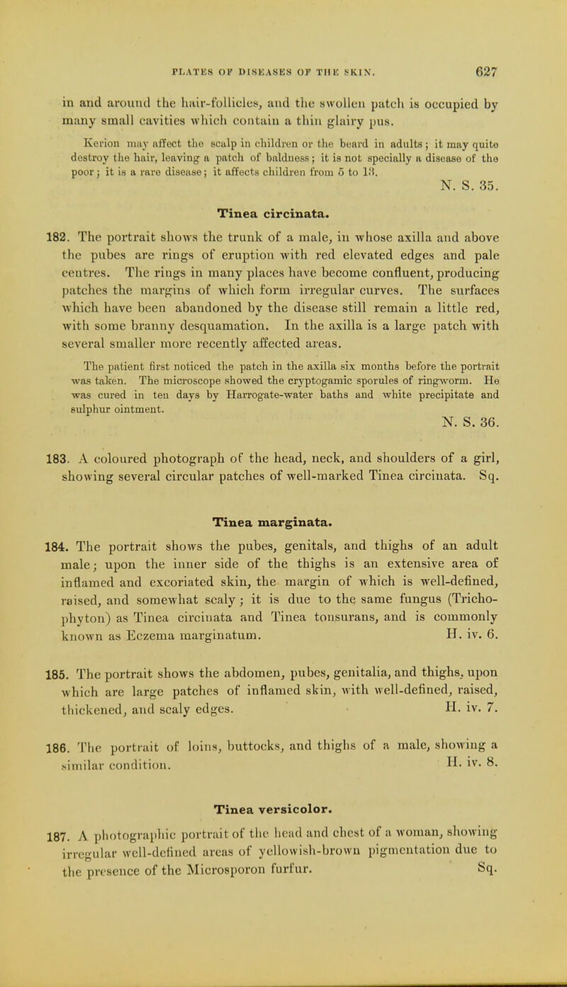 in and around the hair-follicles, and the swollen patch is occupied by many small cavities which contain a thin glairy pus. Kerion may affect the scalp in children or the beard in adults; it may quite destroy the hair, leaving a patch of baldness; it is not specially a disease of the poor; it is a rare disease; it affects children from 5 to IM. N. S. 35. Tinea circinata. 182. The portrait shows the trunk of a male, in whose axilla and above the pubes are rings of eruption with red elevated edges and pale centres. The rings in many places have become confluent, producing patches the margins of which form irregular curves. The surfaces which have been abandoned by the disease still remain a little red, with some branny desquamation. In the axilla is a large patch with several smaller more recently affected areas. The patient first noticed the patch in the axilla six months before the portrait was taken. The microscope showed the cryptogamic sporules of ringworm. He was cured in ten days by Harrogate-water baths and white precipitate and sulphur ointment. N. S. 36. 183. A coloured photograph of the head, neck, and shoulders of a girl, showing several circular patches of well-marked Tinea circinata. Sq. Tinea marginata. 184. The portrait shows the pubes, genitals, and thighs of an adult male; upon the inner side of the thighs is an extensive area of inflamed and excoriated skin, the margin of which is well-defined, raised, and somewhat scaly; it is due to the same fungus (Tricho- phyton) as Tinea circinata and Tinea tonsurans, and is commonly known as Eczema marginatum. H. iv. 6. 185. The portrait shows the abdomen, pubes, genitalia, and thighs, upon which are large patches of inflamed skin, with well-defined, raised, thickened, and scaly edges. H. iv. 7. 186. The portrait of loins, buttocks, and thighs of a male, showing a similar condition. i^'- 8- Tinea versicolor. 187. A photographic portrait of the head and chest of a woman, showing irregular well-defined areas of yellowish-brown pigmentation due to the presence of the Microsporon furfur. Sq.