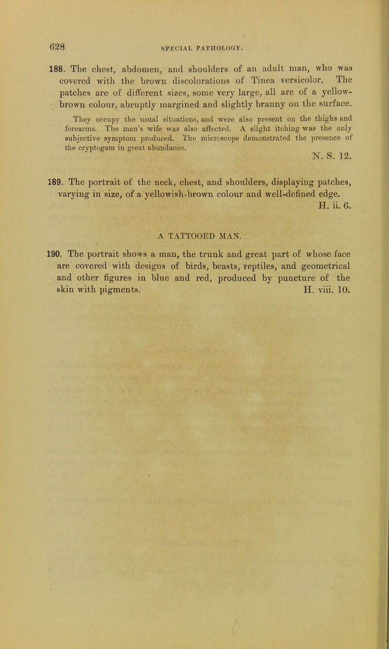 (528 188. The chest, abdomen, and shoulders of an adult man, who was covered with the brown discolorations of Tinea versicolor. The patches are of different sizes, some very large, all are of a yellow- brown colour, abruptly margined and slightly branny on the surface. They occupy the usual situations, and were also present on the thighs and forearms. The man's wife Avas also affected. A slight itching was the only subjective symptom produced. The microscope demonstrated the presence of the cryptogam in great abundance. N. S. 12. 189. The portrait of the neck, chest, and shoulders, displaying patches, varying in size, of a yellowish-brown colour and well-defined edge. H. ii. 6. A TATTOOED MAN. 190. The portrait shows a man, the trunk and great part of whose face are covered with designs of birds, beasts, reptiles, and geometrical and other figures in blue and red, produced by puncture of the