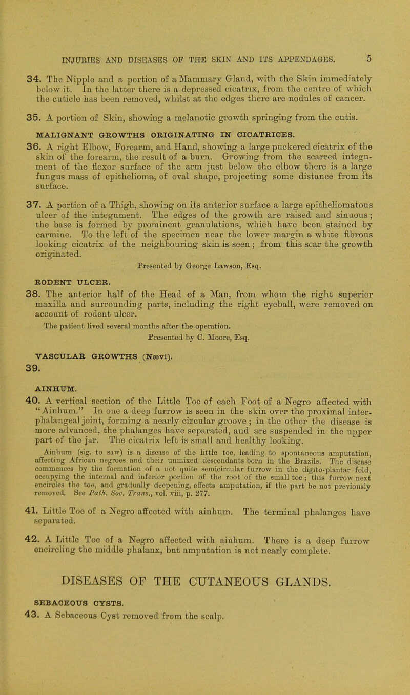 34. The Nipple and a portion of a Mammary Gland, witli the Skin immediately below it. hi the latter there is a depressed cicatrix, from the centre of which the cuticle has been removed, whilst at the edges there are nodules of cancer. 35. A portion of Skin, showing a melanotic growth springing from the cutis. MAIilGHTANT GROWTHS OBIGINATING IN CICATRICES. 36. A right Elbow, Forearm, and Hand, showing a large puckered cicatrix of the skin of the forearm, the result of a burn. Growing from the scarred integu- ment of the flexor surface of the arm just below the elbow there is a large fungus mass of epithelioma, of oval shape, projecting some distance from its surface. 37. A portion of a Thigh, showing on its anterior surface a large epitheliomatous ulcer of the integument. The edges of the growth are raised and sinuous; the base is formed by prominent granulations, which have been stained by carmine. To the left of the specimen near the lower mai-gin a white fibrous looking cicatrix of the neighbouring skin is seen ; from this scar the growth originated. Presented by George Lawson, Esq. RODENT ULCER. 38. The anterior half of the Head of a Man, from whom the right superior maxilla and surrounding parts, including the right eyeball, were removed on account of rodent ulcer. The patient lived several months after the operation. Presented by C. Moore, Esq. VASCULAR GROWTHS (Nsevi). 39. AINHTJM. 40. A vertical section of the Little Toe of each Foot of a Negro affected with  Ainhum. In one a deep furrow is seen in the skin over the proximal inter- phalangeal joint, forming a nearly circular groove ; in the other the disease is more advanced, the phalanges have separated, and are suspended in the upper part of the jar. The cicatrix left is small and healthy looking. Ainhum (sig. to saw) is a disease of the little toe, leading to spontaneous amputation, affecting African negroes and their unmixed descendants born in the Brazils. The disease commences by the formation of a not quite semicircular furrow in the digito-plantar fold, occupying the internal and inferior portion of the root of the small toe ; this furrow next encircles the toe, and gradually deepening, effects amputation, if the part be not previously removed. See Falh. Soc. Trans., vol. viii, p. 277. 41. Little Toe of a Negro affected with ainhum. The terminal phalanges have separated. 42. A Little Toe of a Negro affected with ainhum. There is a deep furrow encircling the middle phalanx, but amputation is not nearly complete. DISEASES OF THE CUTANEOUS GLANDS. SEBACEOUS CYSTS. 43. A Sebaceous Cyst removed from the scalp.