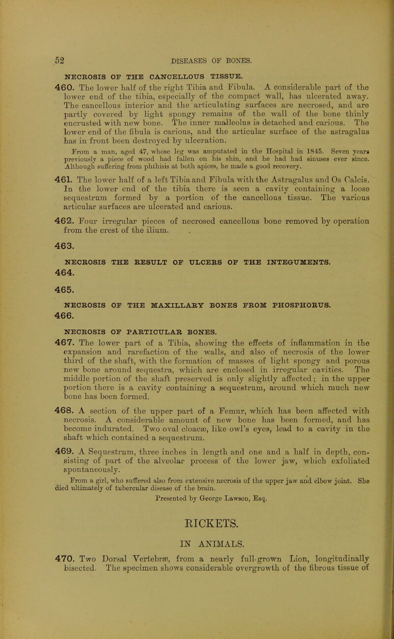 NECROSIS OF THE CANCELLOXTS TISSUE. 460. Tlie lower half of tlie right Tibia and Fibula. A considerable part of the lower end of the tibia, especially of the comjiact wall, lias ulcerated away. The cancellous interior and the articulating surfaces are necrosed, and are partly covered by light spongy remains of the wall of the bone thinly encrusted with new bone. The inner malleolus is detached and carious. The lower end of the fibula is carious, and the articular surface of the astragalus has in front been destroyed by ulceration. From a man, aged 47, whose leg ■was amputated in the Hospital in 1845. Seven yeara preyiously a piece of wood had fallen on his shin, and he had had sinuses ever since. Although suffering from phthisis at both apices, he made a good recovery. 461. The lower half of a left Tibia and Fibula with the Astragalus and Os Calcis. In the lower end of the tibia there is seen a cavity containing a loose sequestrum formed by a portion of the cancellous tissue. The various articular surfaces are ulcerated and carious. 462. Four irregular pieces of necrosed cancellous bone removed by operation from the crest of the ilium. 463. NECROSIS THE RESULT OE ULCERS OF THE INTEGUMENTS. 464. 465. NECROSIS OF THE MAXILLARY BONES FROM PHOSPHORUS. 466. NECROSIS OF PARTICULAR BONES. 467. The lower part of a Tibia, showing the effects of inflammation in the expansion and rarefaction of the walls, and also of necrosis of the lower third of the shaft, with the formation of masses of light spongy and porous new bone around sequestra, which are enclosed in irregular cavities. The middle portion of the shaft preserved is only slightly affected; in the upper portion there is a cavity containing a sequestrum, around which much new bone has been formed. 468. A section of the upper part of a Femur, which has been affected with necrosis. A considerable amount of new bone has been formed, and has become indurated. Two oval cloaca, like owl's eyes, lead to a cavity in the shaft which contained a sequestrum. 469. A Sequestrum, three inches in length and one and a half in depth, con- sisting of part of the alveolar process of the lower jaw, which exfoliated spontaneously. From a girl, who suffered also from extensive necrosis of the upper jaw and elbow joint. She died ultimately of tubercular disease of the brain. Presented by George Lawson, Esq. EICKETS. IN ANIMALS. 470. Two Dorsal Vertebrse, from a nearly full-grown Lion, longitudinally bisected. The specimen shows considerable overgrowth of the fibrous tissue of
