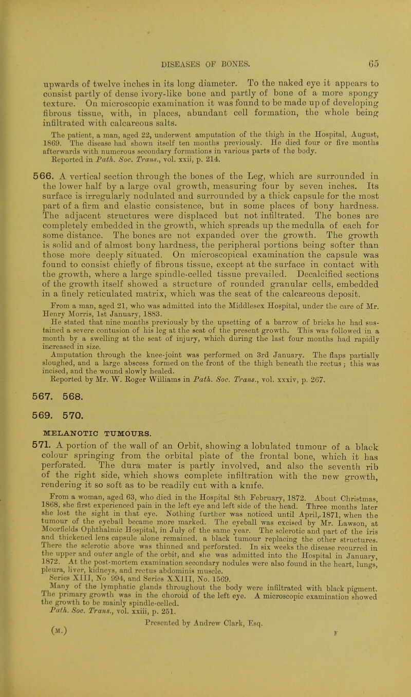 upwards of twelve inches in its long diameter. To the naked eye it appears to consist partly of dense ivory-like bono and partly of bone of a moi-e spongy texture. On microscopic examination it was found to be made up of developing fibrous tissue, with, in places, abundant cell formation, the whole being infiltrated with calcareous salts. The patient, a man, aged 22, iindorwcnt amputation of the tliigh in the Hospital, August, 1869. The disease liad sliown itself ton mouths previously, lie died four or five months afterwards with numerous sccoudarj formations in various parts of the body. Eeported in Path. Soc. Trans., vol. xxii, p. 214. 566. A vertical section through the bones of the Leg, which are surrounded in the lower half by a large oval growth, measuring four by seven inches. Its surface is irregularly nodulated and surrounded by a thick capsule for the most part of a firm and elastic consistence, but in some places of bony hardness. The adjacent structures were displaced but not infiltrated. The bones are completely embedded in the growth, which spreads up the medulla of each for some distance. The bones are not expanded over the growth. The growth is solid and of almost bony hardness, the peripheral portions being softer than those more deeply situated. On microscopical examination the capsule was found to consist chiefly of fibrous tissue, except at the surface in contact with the gi-owth, whei'e a lai'ge spindle-celled tissue prevailed. Decalcified sections of the growth itself showed a structure of rounded granular cells, embedded in a finely reticulated matrix, which was the seat of the calcareous deposit. From a man, aged 21, who was admitted into the Middlesex Hospital, under the care of Mr. Henry Morris, 1st January, 1883. He stated that nine months previously by the upsetting of a barrow of bricks he had sus- tained a severe contusion of his leg at the seat of the present growth. This was followed in a month by a swelling at the seat of injury, which during the last four months had rapidly increased in size. Amputation through the knee-joint was performed on 3rd January. The flaps partially sloughed, and a large abscess formed on the front of the thigh beneath the rectus ; this was incised, and the wound slowly healed. Eeported by Mr. W. Roger Williams in Path. Soc. Trans., vol. xxxiv, p. 267. 567. 568. 569. 570. MELANOTIC TUMOURS. 571. A portion of the wall of an Orbit, showing a lobulated tumour of a black colour springing from the orbital plate of the frontal bone, which it has perforated. The dura mater is partly involved, and also the seventh rib of the right .side, which shows complete infiltration with the new growth, rendering it so soft as to be readily cut with a knife. From a woman, aged 63, who died in the Hospital 8th February, 1872. About Christmas, 1868, she first experienced pain in the left eye and left side of the head. Three months later she lost the sight in tliat eye. Nothing further was noticed until April,. 1871, when tlie tumour of the eyeball became more marked. The eyeball was excised by Mr. Lawson, at Moorfields Ophthalmic Hospital, in July of the same year. The sclerotic and part of the 'iris and thickened lens capsule alone remained, a black tumour replacing the other structures. There the sclerotic above wiis thinned and perforated. In six weeks the disease recurred in the upper and outer angle of the orbit, and she was admitted into the Hospital in January, 1872. At the post-mortem examination secondary nodules were also found in the heart, lungs' pleura, liver, kidneys, and rectus abdominis muscle. Series XIII, No 994, and Scries XXIII, No. 1569. Many of the lymphatic glands throughout the body were infiltrated with black pigment. The primary growtli was in the choroid of the left eye. A microscopic examination showed the growth to be mainly spindle-cellcd. Path. Soc. Trans., vol. x.xiii, p. 251. Presented by Andrew Clark, Esq.