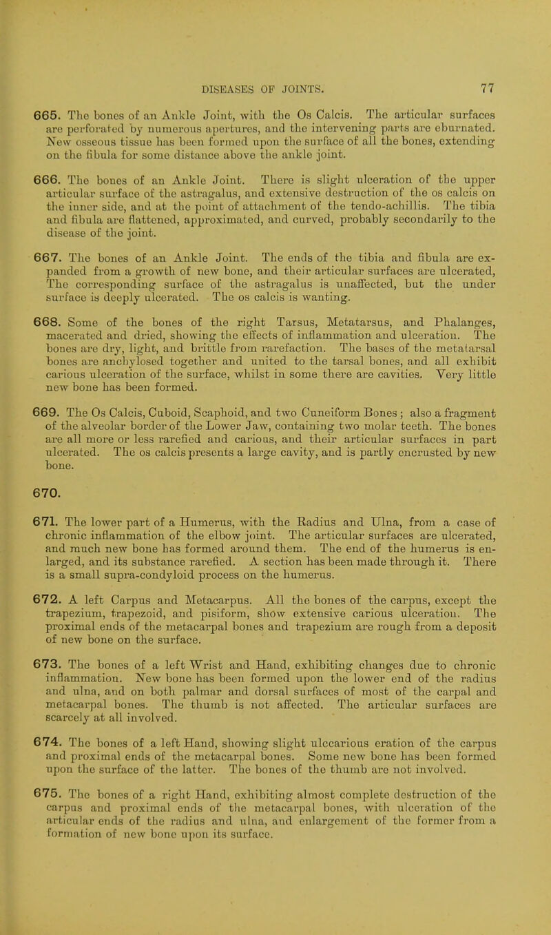 665. The bones of an Ankle Joint, with the Os Calcis. The articular surfaces are perforated by numerous apertures, and the intervening- parts are eburnated. New osseous tissue has been formed upon tlie surface of all the bones, extending on the fibula for some distance above the ankle joint. 666. The bones of an Ankle Joint. There is slight ulceration of the upper articular surface of the astragalus, and extensive destruction of the os calcis on the inner side, and at the point of attachment of the tendo-achillis. The tibia and fibula are flattened, approximated, and curved, probably secondarily to the disease of the joint. 667. The bones of an Ankle Joint. The ends of the tibia and fibula are ex- panded from a growth of new bone, and their articular surfaces are ulcerated. The corresponding surface of the astragalus is unafiected, but the under surface is deeply ulcerated. The os calcis is wanting. 668. Some of the bones of the right Tarsus, Metatarsus, and Phalanges, macerated and dried, showing the effects of inflammation and ulceration. The bones are dry, light, and brittle from rax-efaction. The bases of the metatarsal bones are anchylosed together and united to the tarsal bones, and all exhibit carious ulceration of the surface, whilst in some thei-e are cavities. Very little new bone has been formed. 669. The Os Calcis, Cuboid, Scaphoid, and two Cuneiform Bones ; also a fragment of the alveolar border of the Lower Jaw, containing two molar teeth. The bones ai-e all more or less rarefied and carioas, and their articular surfaces in part ulcerated. The os calcis presents a large cavity, and is partly encrusted by new bone. 670. 671. The lower part of a Humerus, with the Radius and Ulna, from a case of chronic inflammation of the elbow joint. The articular surfaces are ulcerated, and much new bone has formed aronnd them. The end of the humerus is en- larged, and its substance rarefied. A section has been made through it. There is a small supra-condyloid process on the humerus. 672. A left Carpus and Metacarpus. All the bones of the carpus, except the trapezium, trapezoid, and pisiform, show extensive carious ulceration. The proximal ends of the metacarpal bones and trapezium are rough from a deposit of new bone on the surface. 673. The bones of a left Wrist and Hand, exhibiting changes due to chronic inflammation. New bone has been formed upon the lower end of the radius and ulna, and on both palmar and dorsal surfaces of most of the carpal and metacarpal bones. The thumb is not affected. The articular surfaces are scarcely at all involved. 674. The bones of a left Hand, showing slight ulccarious eration of the carpus and proximal ends of the metacarpal bones. Some new bone has been formed upon the surface of the latter. The bones of the thumb ai'o not involved. 675. The bones of a right Hand, exhibiting almost complete destruction of the carpus and proximal ends of the metacarpal bones, with ulceration of the articular ends of the radius and uhia, and enlargement of the former from a formation of new bone upon its surf.ace.