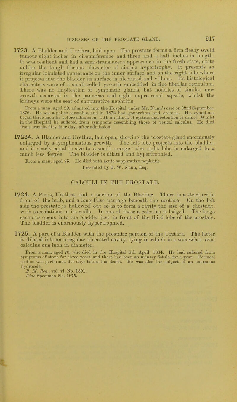 1723. A Bladder and Urethra, laid open. The prostate forms a firm fleshy ovoid tumoiir eiofhfc inches in circumference and three and a half inches in length. It was resilient and had a semi-translucent appearance in tlie fi-esh state, quite unlike the tou<>h fihroas character of simple hypertrophy. It presents an irregular lobuiated appearance on the inner surface, and on the right side where it projects into the bladder its surface is ulcerated and villous. Its histological characters wore of a small-celled growth embedded in fiiie fibrillar reticulum. Tiiere was no implication of lymphatic glands, but nodules of similar new growth occu.rred in the pancreas and right supra-renal capsule, whilst the kidneys were the seat of suppurative nephritis. From a man, aged 29, admitted into tlie Hospital under Mr. Nunn's care on 22nd September, 3876. Ho was a police constable, and in 1872 had gonorrliosa and orchitis. His symptoms began three montlis before admission, Avitli an attack of cystitis and retention of urine. AVhilst in the Hospital lie sufTered from symptoms resembling those of vesical calcidus. He died from lU'iEmia fifty-four days after admission. 1723A-. A Bladder and Urethra, laid open, showing the prostate gland enormously enlarged by a lymphomatous growth. The left lobe projects into the bladder, and is nearly equal in size to a small orange; the right lobe is enlarged to a much less degree. The bladder is dilated and hypertrophied. From a man, aged 75. He died with acute suppuratiye nephritis. Presented by T. W. Nunn, Esq. CALCULI IN THE PEOSTATE. 1724. A Penis, Urethra, and a portion of the Bladder. There is a stricture in front of the bulb, and a long false passage beneath the urethra. On the left side the prostate is hollowed out so as to form a cavity the size of a chestnut, with sacculations in its walls. In one of these a calculus is lodged. The large sacculus opens into the bladder just in front of the thii-d lobe of the prostate. The bladder is enormously hypertrophied. 1725. A part of a Bladder with the prostatic portion of the Urethra. The latter is dilated into an irregular ulcerated cavity, lying in which is a somewhat oval calculus one inch in diameter. From a man, aged 70, who died in the Hospital 8th April, 1864. He had suffered from symptoms of stone for three years, and there had been an urinary fistula for a year. Perineal section was performed five days before his death. He was also the subject of an enormous hydrocele. P. ilf. Reff., vol. vi, No. 1801. Vide Specimen No. 1675.