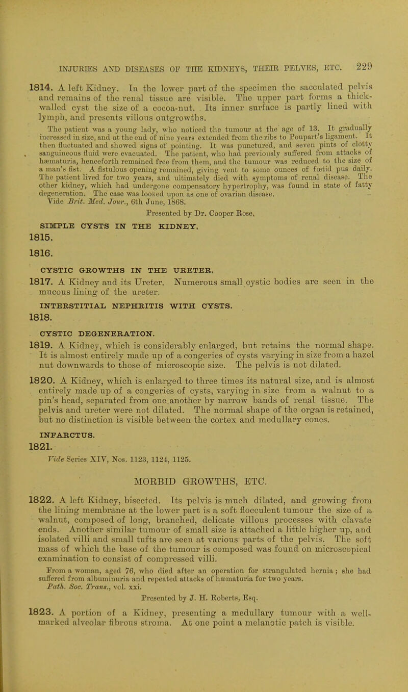 1814. A left Kidney. In the lower jsart of the specimen the sacculated pelvis and remains of the renal tissue are visible. The upper part forms a thick- wallod cyst the size of a cocoa-nut. Its inner surface is partly lined with lymph, and presents villous outgrowths. The putient was a young lady, who noticed the tumour at the age of 13. It gradually increased in size, and at tlie end of nine years extended from the ribs to Poupart's ligament. It then fluctuated and showed signs of pointing. It was pimetured, and seven pints of clotty sanguineous fluid were evacuated. The patient, who had previously sutfered from attacks of htematuria, henceforth remained free from them, and the tumour was reduced to the size of a man's list. A fistulous opening remained, giving vent to some ounces of foetid pus daily. The patient lived for two years, and ultimately died with symptoms of renal disease- The other kidney, which had imdergone compensatory hypertrophy, was found in state of fatty degeneration. The ease was looked upon as one of ovarian disease. Vide £rit. Med. Jour., 6th June, 1868. Presented by Dr. Cooper Rose, SIMPLE CYSTS IN THE KIDNEY, 1815. 1816. CYSTIC GROWTHS IN THE URETER. 1817. A Kidney and its Ureter, Numerous small cystic bodies are seen in the mucous lining of the ureter. INTERSTITIAL NEPHRITIS WITH CYSTS. 1818. CYSTIC DEGENERATION. 1819. A Kidney, which is considerably enlarged, but retains the normal shape. It is almost entii-ely made up of a congeries of cysts varying in size from a hazel nut downwards to those of microscopic size. The pelvis is not dilated. 1820. A Kidney, which is enlarged to three times its natural size, and is almost entirely made up of a congeries of cysts, varying in size from a walnut to a pin's bead, separated from one.another by narrow bands of renal tissue. The pelvis and ureter were not dilated. The normal shape of the organ is retained, but no distinction is visible between the cortex and medullary cones. INFARCTITS. 1821. Vide Series XIV, Nos. 1123, 1121, 1125. MOEBID GROWTHS, ETC. 1822. A left Kidney, bisected. Its pelvis is much dilated, and growing from the lining membrane at the lower part is a soft flocculent tumour the size of a walnut, composed of long, branched, delicate villous processes with clavate ends. Another similar tumour of small size is attached a little higher up, and isolated villi and small tufts are seen at various parts of the pelvis. The soft mass of which the base of the tumour is composed was found on microscopical examination to consist of compressed villi. From a woman, aged 76, who died after an operation for strangulated hernia; she had suffered from albuminuria and repeated attacks of hcematuria for two years. Fath. Soc. Trans., vol. xxi. Presented by J. H. Roberts, Esq. 1823. A portion of a Kidney, presenting a medullaiy tumour with a Avell- marked alveolar fibrous stroma. At one point a melanotic patch is visible.