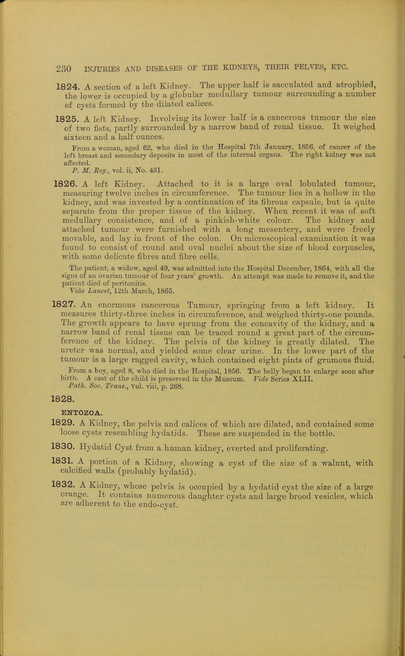 1824. A section of a left Kidney. The upper half is sacculated and atrophied, the lower is occupied by a globular medullary tumour surrounding a number of cysts formed by the dilated calices. 1825. A left Kidney. Involving its lower half is a cancerous tumour the size of two fists, partly surrounded by a narrow band of renal tissue. It weighed sixteen and a half ounces. From a woman, aged 62, who died in the Hospital 7th January, 1856, of cancer of the left breast and secondary deposits in most of the internal organs. The right kidney was not affected. P. M. Reg., vol. ii, No. 431. 1826. A left Kidney. Attached to it is a large oval lobulated tumour, measui'ina' twelve inches in circumference. The tumour lies in a hollow in the kidney, and was invested by a continuation of its fibrous capsule, but is quite separate from the proper tissue of the kidney. When recent it was of soft medullary consistence, and of a pinkish-white colour. The kidney and attached tumoni- were furnished with a long mesentery, and were freely movable, and lay in fi-ont of the colon. On microscopical examination it was found to consist of round and oval nuclei about the size of blood corpuscles, with some delicate fibres and fibre cells. The patient, a widow, aged 49, was admitted into the Hospital Decemher, 1864, with all the signs of an ovarian tumour of four years' growth. An attempt was made to remove it, and the patient died of peritonitis. Vide Lancet, 12th March, 1865. 1827. An enonnous cancerous Tumour, springing from a left kidney. It measures thirty-three inches in circumference, and weighed thirty-one pounds. The growth appears to have sprung from the concavity of the kidney, and a narroAv band of renal tissue can be traced round a great part of the circum- ference of the kidney. The pelvis of the kidney is greatly dilated. The ureter was normal, and yielded some clear urine. In the lower part of the tumour is a large ragged cavity, which contained eight pints of grumous fluid. From a boy, aged 8, who died in the Hospital, 1856. The belly began to enlarge soon after birth. A cast of the child is preserved in the Museum. Vide Series XLII. Path. Soc. Trans., vol. viii, p. 268. 1828. ENTOZOA. 1829. A Kidney, the pelvis and calices of which are dilated, and contained some loose cysts resembling hydatids. These are suspended in the bottle. 1830. Hydatid Cyst from a human kidney, everted and proliferating. 1831. A portion of a Kidney, showing a cyst of the size of a walnut, with calcified walls (probably hydatid). 1832. A Kidney, whose pelvis is occupied by a hydatid cyst the size of a large orange. It contains numerous daughter cysts and large brood vesicles, which are adherent to the endo-cyst.