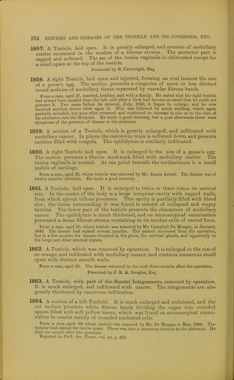 1857. A Testicle, laid open. It is greatly enlarged, and consists of medullary matter contained in the meshes of a fibrous stroma. _ The posterior part is rao-o-ed and softened. The sac of the tunica vaginalis is obliterated except for a small space at the top of the testicle. Presented by B. Cartwright, Esq. 1858. A right Testicle, laid open and injected, forming an oval tumour the size of a goose's egg. The section presents a congeries of more or less distinct round nodules of medullary tissue separated by vascular fibrous bands. Erom a man, aged 37, married, healthy, and with a family. He stated that the right testicle had always been smaller than the left, and after a blow had become so small that lie could not perceive it. Two years before its removal, July, 1850, it began to enlarge, and he now received another severe blow upon it. This was followed by much swelling, which again partially subsided, but soon after returned and continued to increase in size up to the time of his admission into the Hospital. He made a good recovery, but a year afterwards there were symptoms of the presence of disease in the abdomen. 1859. A section of a Testicle, which is greatly enlarged, and infiltrated with medullary cancer. In places the cancerous mass is softened down, and presents cavities tilled with coagula. The epididymis is similarly infiltrated. 1860. A right Testicle laid open. It is enlarged to the size of a goose's egg. The section presents a fibrous meshwork filled with medullary matter. The tunica vaginalis is normal. At one point beneath the mediastinum is a small nodule of cartilage. From a man, aged 25, whose testicle was removed by Mr. James Arnott. The disease was of twelve months' duration. He made a good recovery. 1861. A Testicle, laid open. It is enlarged to twice or three times its natural size. In the centre of the body is a large irregular cavity with ragged walls, from wbich sprout villous processes. This cavity is partially filled with, blood clot; the tissue surrounding it was found to consist of collapsed and empty tubules. The lower part of the testicle presents the characters of medullary cancer. The epididymis is much, thickened, and on microscopical examination presented a dense fibrous stroma containing in. its meshes cells of varied form. From a man, aged 50, whose testicle was removed by Mr. Campbell De Morgan, in January, 1849. The disease had existed several months. The patient recovered from the operation, but in a few months the disease returned in the groin, the cervical glands, and apparently in the lungs and other internal organs. 1862. A Testicle, whicb was removed by operation. It is enlarged to the size of an orange, and infiltrated with medullary cancer, and contains numerous small cysts with distinct smooth walls. From a man, aged 25. The disease returned in the cord three months after the operation. Presented by J. R. A. Douglas, Esq. 1863. A Testicle, with part of tbe Scrotal Integuments, removed by operation. It is much enlarged, and infiltrated with cancer. The integuments are also greatly thickened by cancerous infiltration. 1864. A section of a left Testicle. It is much enlarged and nodulated, and the cut surface presents white fibrous bands dividing the organ into rounded spaces filled with soft yellow tissue, whicli was found on microscopical exami- nation to consist mainly of rounded nucleated cells. From a man, aged 38, whose testicle was removed by Mr. De Morgan in May, 1869. The tumour had existed for twelve years. There was also a cancerous tumour in the abdomen. He died one month after the operation. Reported in Path. Soc. Trans., vol. xx, p. 250.