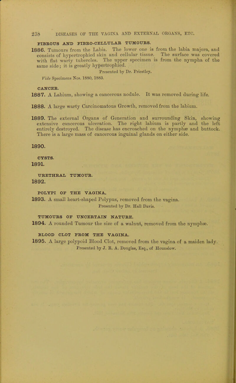 FIBBOTTS AND FIBRO-CEIiLTTLAR TTTMOITKS. 1886. Tumours from the Labia. The lower one is from the labia majora, and consists of hypertrophied skin and cellular tissue. The surface was covered with flat warty tubercles. The upper specimen is from the nympha of the same side; it is greatly hypertrophied. Presented by Dr. Priestley. Vide Specimens Nos. 1880,1883. CANCER. 1887. A Labium, showing a cancerous nodule. It was removed during life. 1888. A large warty Carcinomatous Growth, removed from the labium. 1889. The external Organs of Generation and surrounding Skin, showing extensive cancerous ulceration. The right labium is partly and the left entirely destroyed. The disease has encroached on the nymphae and buttock. There is a large mass of cancerous inguinal glands on either side. 1890. CYSTS. 1891. URETHRAL TUMOUR. 1892. POLYPI OP THE VAGINA. 1893. A small heart-shaped Polypus, removed from the vagina. Presented by Dr. Hall Davis. TUMOURS OP UNCERTAIN NATURE, 1894. A rounded Tumour the size of a walnut, removed from the nymphse. BLOOD CLOT PROM THE VAGINA, 1895. A large polypoid Blood Clot, removed from the vagina of a maiden lady, Presented by J. E. A. Douglas, Esq., of Hounslow.
