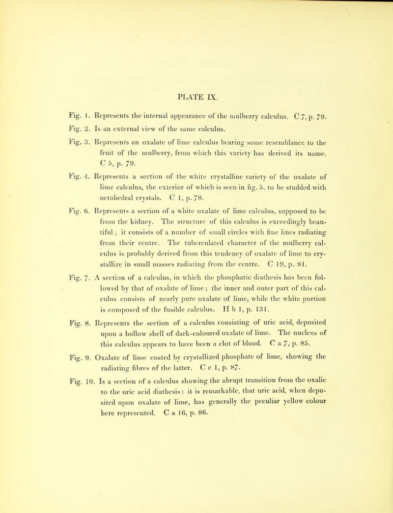 Fig. ]. Represents the internal appearance of the mulberry calculus. C 7, p. 79. Fig. 2. Is an external view of the same calculus. Fig. 3. Represents an oxalate of lime calculus bearing some resemblance to the fruit of the mulberry, from which this variety has derived its name. C b, p. 79. Fig. 4. Represents a section of the white crystalline variety of the oxalate of lime calculus, the exterior of which is seen in fig. 5. to be studded with octohedral crystals. C l,p. 78. Fig. 6. Represents a section of a white oxalate of lime calculus, supposed to be from the kidney. The structure of this calculus is exceedingly beau- tiful ; it consists of a number of small circles with fine lines radiating from their centre. The tuberculated character of the mulberry cal- culus is probably derived from this tendency of oxalate of lime to cry- stallize in small masses radiating from the centre. C 19, p. 81. Fig. 7. A section of a calculus, in which the phosphatic diathesis has been fol- lowed by that of oxalate of lime ; the inner and outer part of this cal- culus consists of nearly pure oxalate of lime, while the white portion is composed of the fusible calculus. H b 1, p. 131. Fig. 8. Represents the section of a calculus consisting of uric acid, deposited upon a hollow shell of dark-coloured oxalate of lime. The nucleus of this calculus appears to have been a clot of blood. C a 7, p. 85. Fig. 9. Oxalate of lime coated by crystallized phosphate of lime, showing the radiating fibres of the latter. C c 1, p. 87- Fig. 10. Is a section of a calculus showing the abrupt transition from the oxalic to the uric acid diathesis : it is remarkable, that uric acid, when depo- sited upon oxalate of lime, has generally the peculiar yellow colour here represented. C a 16, p. 86.