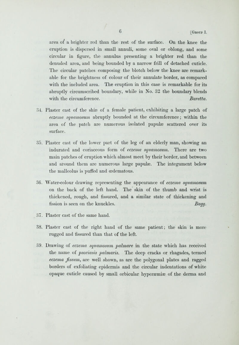 / 6 [Group I. area a brighter red than the rest of the surface. On the knee the eruption is dispersed in small annuli, some oval or oblong, and some circular in figure, the annulus presenting a brighter red than the denuded area, and being bounded by a narrow frill of detached cuticle. The circular patches composing the blotch below the knee are remark- able for the brightness of colour of their annulate border, as compared with the included area. The eruption in this case is remarkable for its abruptly circumscribed boundary, while in No. 32 the boundary blends with the circumference. Baretta. 34. Plaster cast of the shin of a female patient, exhibitmg a large patch of eczema squamosum abruptly bounded at the circumference; within the area of the patcli are numerous isolated papulae scattered over its surface. 35. Plaster cast of the lower part of the leg of an elderly man, showing an indurated and coriaceous form of eczema sqiiamosmn. There are two main patches of eruption which almost meet by their border, and between and around them are numerous large papulse. The integument below the malleolus is puffed and cedematous. 36. Water-colour drawing representing the appearance of eczema squamosum on the back of the left hand. The skin of the thumb and wrist is thickened, rough, and fissured, and a similar state of thickening and fission is seen on the knuckles. Bagg. 37. Plaster cast of the same hand. 38. Plaster cast of the right hand of the same patient; the skin is more rugged and fissured than that of the left. 39. Drawing of eczema squamosum palmare in the state which has received the name of psoriasis palmaris. The deep cracks or rhagades, termed eczema Jissum, are well shown, as are the polygonal plates and ragged borders of exfoliating epidermis and the circular indentations of white opaque cuticle caused by small orbicular hypersemiae of the derma and
