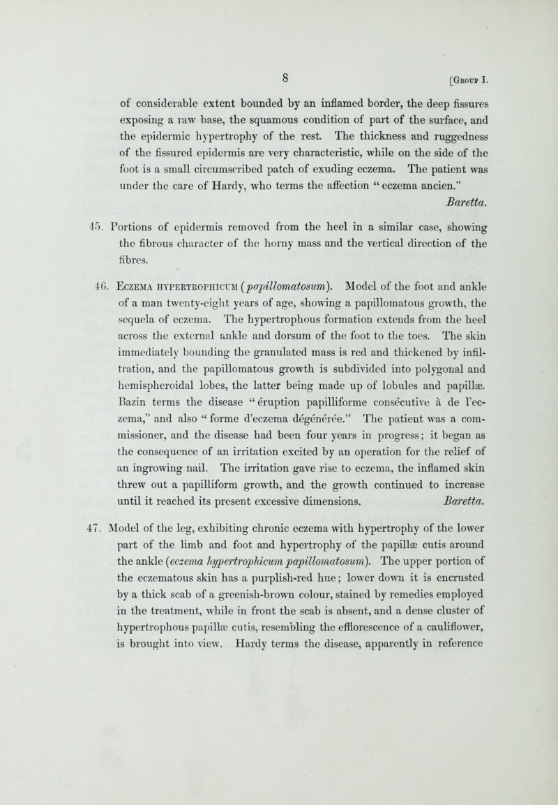 of considerable extent bounded by an inflamed border, the deep fissures exposing a raw base, the squamous condition of part of the surface, and the epidermic hypertrophy of the rest. The thickness and ruggedness of the fissured epidermis are very characteristic, while on the side of the foot is a small circumscribed patch of exuding eczema. The patient was under the care of Hardy, who terms the aficction eczema ancien. Baretta. 45. Portions of epidermis removed from the heel in a similar case, showing the fibrous character of the horny mass and the vertical direction of the fibres. 4G. Eczema hypertrophicum [painllomatosum). Model of the foot and ankle of a man twenty-eight years of age, showing a papillomatous growth, the sequela of eczema. The hypertrophous formation extends from the heel across the external ankle and dorsum of the foot to the toes. The skin immediately bounding the granulated mass is red and thickened by infil- tration, and the papillomatous growth is subdivided into polygonal and hemispheroidal lobes, the latter being made up of lobules and papillae. Bazin terms the disease eruption papilliforme consecutive a de I'ec- zema, and also forme d'eczema degeneree. The patient was a com- missioner, and the disease had been four years in progress; it began as the consequence of an irritation excited by an operation for the relief of an ingrowing nail. The irritation gave rise to eczema, the inflamed skin threw out a papilliform growth, and the growth continued to increase until it reached its present excessive dimensions. Baretta. 47. Model of the leg, exhibiting chronic eczema with hypertrophy of the lower part of the limb and foot and hypertrophy of the papillae cutis around the ankle {eczema hypertrophicum papillomatosum). The upper portion of the eczematous skin has a purplish-red hue; lower down it is encrusted by a thick scab of a greenish-brown colour, stained by remedies employed in the treatment, while in front the scab is absent, and a dense cluster of hypertrophous papillae cutis, resembling the efflorescence of a cauliflower, is brought into view. Hardy terms the disease, apparently in reference