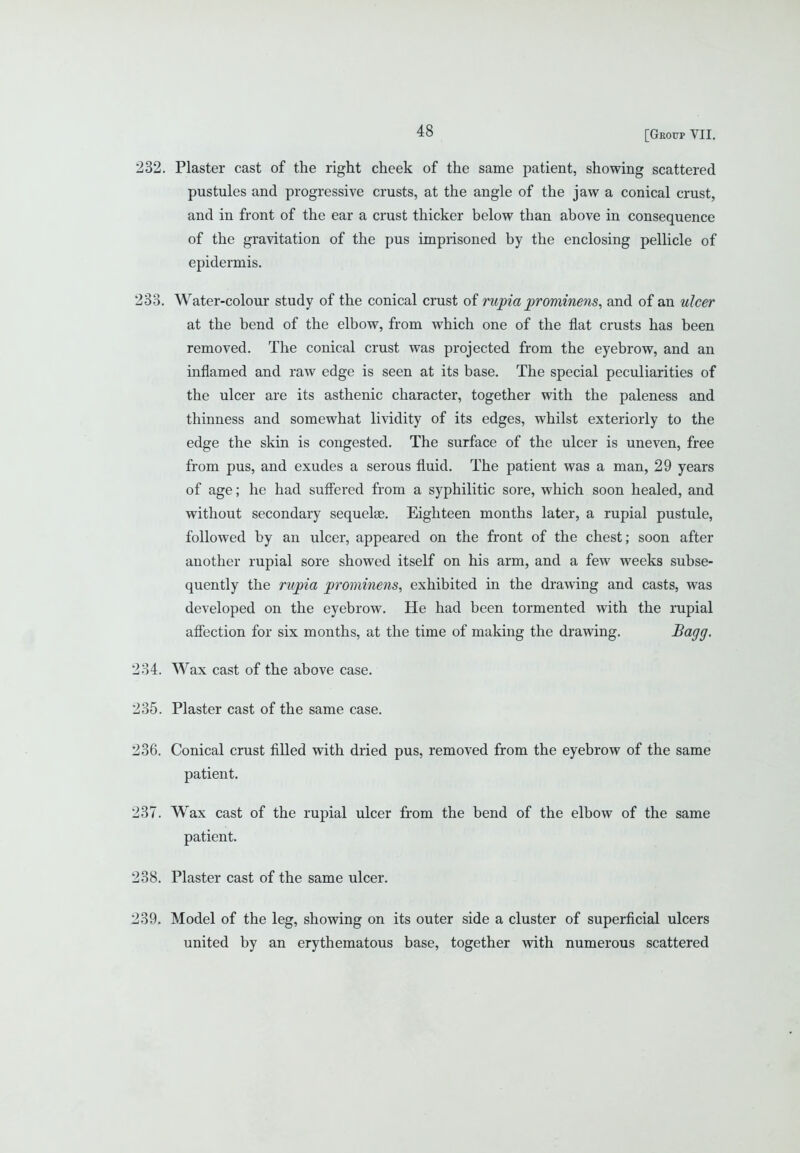 232. Plaster cast of the right cheek of the same patient, showing scattered pustules and progressive crusts, at the angle of the jaw a conical crust, and in front of the ear a crust thicker below than above in consequence of the gravitation of the pus imprisoned by the enclosing pellicle of epidermis. 233. Water-colour study of the conical crust of rupia prominens^ and of an ulcer at the bend of the elbow, from which one of the flat crusts has been removed. The conical crust was projected from the eyebrow, and an inflamed and raw edge is seen at its base. The special peculiarities of the ulcer are its asthenic character, together with the paleness and thinness and somewhat lividity of its edges, whilst exteriorly to the edge the skin is congested. The surface of the ulcer is uneven, free from pus, and exudes a serous fluid. The patient was a man, 29 years of age; he had suffered from a syphilitic sore, which soon healed, and without secondary sequelse. Eighteen months later, a rupial pustule, followed by an ulcer, appeared on the front of the chest; soon after another rupial sore showed itself on his arm, and a few weeks subse- quently the rupia prominens, exhibited in the drawing and casts, was developed on the eyebrow. He had been tormented with the rupial affection for six months, at the time of making the drawing. ^agSf- 234. Wax cast of the above case. 235. Plaster cast of the same case, 236. Conical crust filled with dried pus, removed from the eyebrow of the same patient. 237. Wax cast of the rupial ulcer from the bend of the elbow of the same patient, 238. Plaster cast of the same ulcer. 239. Model of the leg, showing on its outer side a cluster of superficial ulcers united by an erythematous base, together with numerous scattered