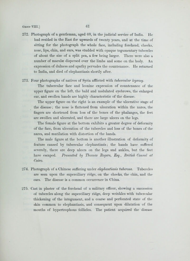 272. Photograph of a gentleman, aged 60, in the judicial senice of India. He had resided in the East for upwards of twenty years, and at the time of sitting for the photograph the whole face, including forehead, cheeks, nose, lips, chin, and ears, was studded with opaque tegumentary tubercles of about the size of a split pea, a few being larger. There were also a number of maculae dispersed over the limbs and some on the body. An expression of dulness and apathy pervades the countenance. He returned to India, and died of elephantiasis shortly after. 273. Four photographs of natives of S)Tia afflicted with tubercular leprosy. The tubercular face and leonine expression of countenance of the upper figure on the left, the bald and nodulated eyebrows, the enlarged ear. and swollen hands are highly characteristic of the disease. The upper figure on the right is an example of the ulcerative stage of the disease; the nose is flattened from ulceration within the nares, the fingers are shortened fi'om loss of the bones of the phalanges, the feet are swollen and ulcerated, and there are large ulcers on the legs. The female figui'e at the bottom exhibits a greater degree of deformity of the face, from ulceration of the tubercles and loss of the bones of the nares, and mutilation with distortion of the hands. The male figure at the bottom is another illustration of deformity of feature caused by tubercular elephantiasis; the hands have suffered severely, there ai*e deep ulcers on the legs and ankles, but the feet have escaped. Fresented hy Thomas JRogers, Esq., British Consul at Cairo. 274. Photograph of a Chinese suffering rmder elephantiasis tuberosa. Tubercles are seen upon the superciliary ridge, on the cheeks, the chin, and the ears. The disease is a common occurrence in China. 275. Cast in plaster of the forehead of a military officer, showing a succession of tubercles along the superciliary ridge, deep wTinkles with tubercular thickening of the integument, and a coarse and perforated state of the skin common to elephantiasis, and consequent upon dilatation of the mouths of hypertrophous follicles. The patient acquired the disease