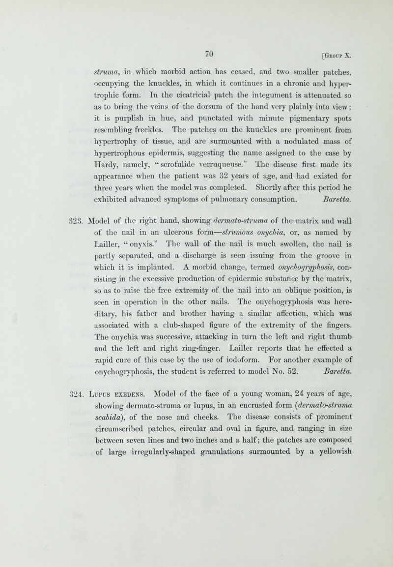 struma, in which morbid action has ceased, and two smaller patches, occupying the knuckles, in which it continues in a chronic and hyper- trophic form. In the cicatricial patch the integument is attenuated so as to bring the veins of the dorsum of the hand very plainly into view; it is purplish in hue, and punctated with minute pigmentary spots resembling freckles. The patches on the knuckles are prominent from hypertrophy of tissue, and are surmounted with a nodulated mass of hypertrophous epidermis, suggesting the name assigned to the case by Hardy, namely,  scrofulide verruqueuse. The disease first made its appearance when the patient was 32 years of age, and had existed for three years when the model was completed. Shortly after this period he exhibited advanced symptoms of pulmonary consumption. Baretta. 323. Model of the right hand, showing dermato-struma of the matrix and wall of the nail in an ulcerous form—strumous onychia, or, as named by Lailler,  onyxis. The wall of the nail is much swollen, the nail is partly separated, and a discharge is seen issuing from the groove in which it is implanted. A morbid change, termed onychogryphosis, con- sisting in the excessive production of epidermic substance by the matrix, so as to raise the free extremity of the nail into an oblique position, is seen in operation in the other nails. The onychogryphosis was here- ditary, his father and brother having a similar affection, which was associated with a club-shaped figure of the extremity of the fingers. The onychia was successive, attacking in turn the left and right thumb and the left and right ring-finger. Lailler reports that he effected a rapid cure of this case by the use of iodoform. For another example of onychogryphosis, the student is referred to model No. 52. Baretta. 324. Lupus exedens. Model of the face of a young woman, 24 years of age, showing dermato-struma or lupus, in an encrusted form {dermato-struma scabida), of the nose and cheeks. The disease consists of prominent circumscribed patches, circular and oval in figure, and ranging in size between seven lines and two inches and a half; the patches are composed of large irregularly-shaped granulations surmounted by a yellowish