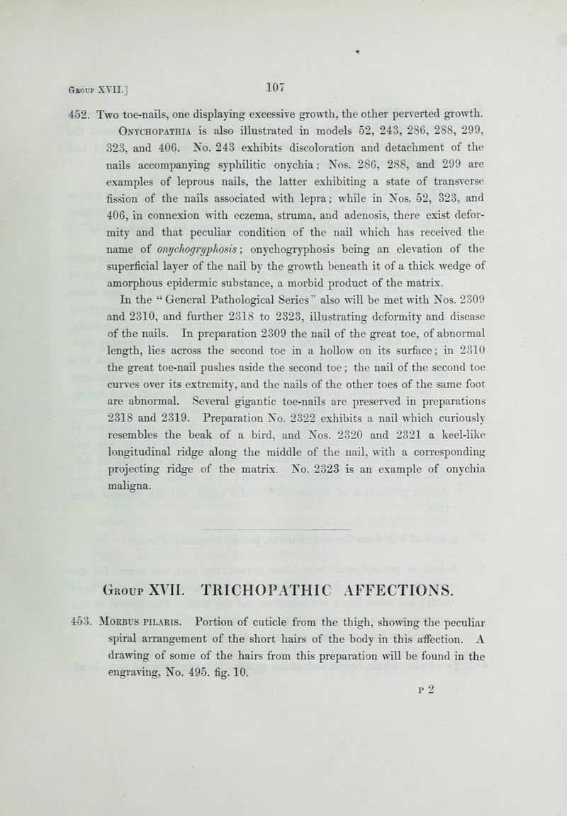 452. Two toe-nails, one displaying excessive growth, the other perverted growth. OxTCHOPATHiA is also illustrated in models 52, 243, 286, 288, 299, 323, and 406. Xo. 243 exhibits discoloration and detachment of the nails accompanying syphilitic onychia; Xos. 286, 288, and 299 are examples of leprous nails, the latter exhibiting a state of transverse fission of the nails associated with lepra; while in Xos. 52, 323, and 406, in connexion with eczema, struma, and adenosis, there exist defor- mity and that peculiar condition of the nail which has received the name of onychogryphosis; onychogryphosis being an elevation of the superficial layer of the nail by the growth beneath it of a thick wedge of amorphous epidermic substance, a morbid product of the matrix. In the General Pathological Series also will be met with Nos. 2309 and 2310, and further 2318 to 2323, illustrating deformity and disease of the nails. In preparation 2309 the nail of the great toe, of abnormal length, lies across the second toe in a hollow on its surface; in 2310 the great toe-nail pushes aside the second toe; the nail of the second toe curves over its extremity, and the nails of the other toes of the same foot are abnormal. Several gigantic toe-nails are preserved in preparations 2318 and 2319. Preparation Xo. 2322 exhibits a nail which curiously resembles the beak of a bird, and Xos. 2320 and 2321 a keel-like longitudinal ridge along the middle of the nail, with a corresponding projecting ridge of the matrix. Xo. 2323 is an example of onychia maligna. Group XVII. TRICHOPATHIC AFFECTIOxNS. 453. MoRBi'S PILARIS. Portion of cuticle from the thigh, showing the peculiar spiral arrangement of the short hairs of the body in this affection. A drawing of some of the hairs from this preparation will be found in the engraving, Xo. 495. fig. 10. p 2