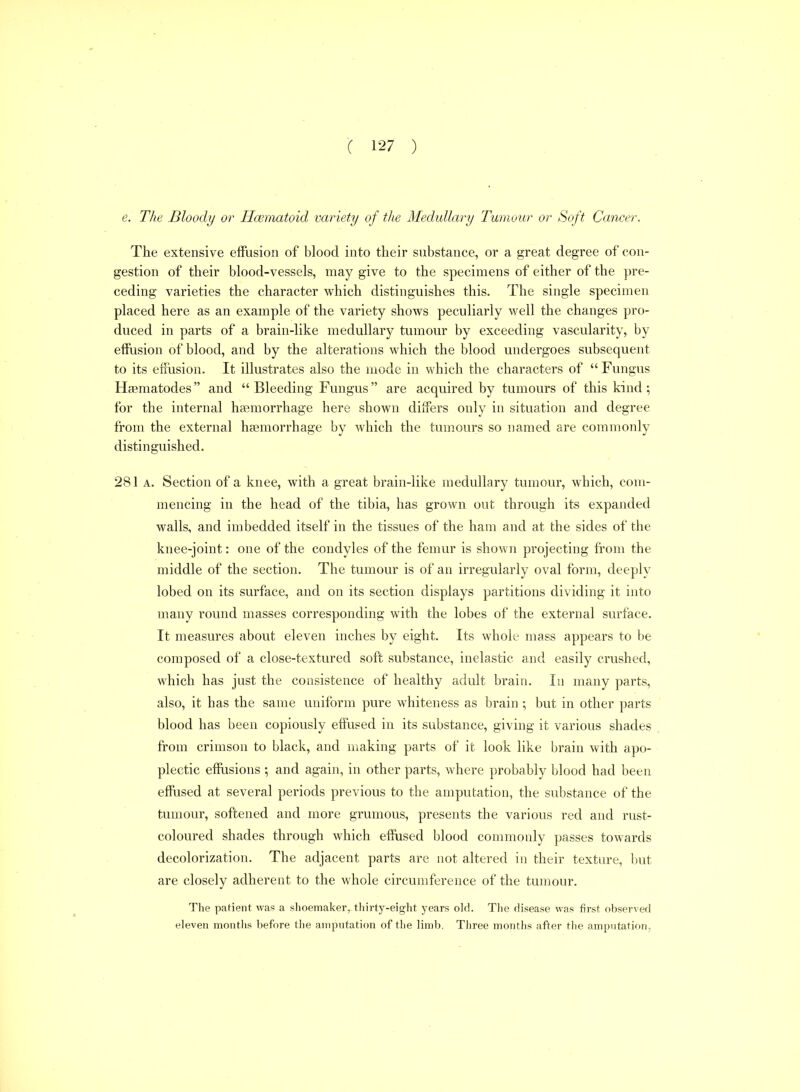 e. The Bloody or Hcematoid variety of tJte Medullary Twnoiir or Soft Cancer. The extensive effusion of blood into their substance, or a great degree of con- gestion of their blood-vessels, may give to the specimens of either of the pre- ceding varieties the character which distinguishes this. The single specimen placed here as an example of the variety shows peculiarly well the changes pro- duced in parts of a brain-like medullary tumour by exceeding vascularity, by effusion of blood, and by the alterations which the blood undergoes subsequent to its effusion. It illustrates also the mode in which the characters of  Fungus Hseraatodes and Bleeding Fungus are acquired by tumours of this kind; for the internal hemorrhage here shown differs only in situation and degree from the external haemorrhage by which the tumours so named are commonly distinguished. 281 A. Section of a knee, with a great brain-like medullary tumour, which, com- mencing in the head of the tibia, has grown out through its expanded walls, and imbedded itself in the tissues of the ham and at the sides of the knee-joint: one of the condyles of the femur is shown projecting from the middle of the section. The tumour is of an irregularly oval form, deeply lobed on its surface, and on its section displays partitions dividing it into many round masses corresponding with the lobes of the external surface. It measures about eleven inches by eight. Its whole mass appears to be composed of a close-textured soft substance, inelastic and easily crushed, which has just the consistence of healthy adult brain. In many parts, also, it has the same uniform pure whiteness as brain ; but in other parts blood has been copiously effused in its substance, giving it various shades from crimson to black, and making parts of it look like brain with apo- plectic effusions ; and again, in other parts, where probably blood had been effused at several periods previous to the amputation, the substance of the tumour, softened and more grumous, presents the various red and rust- coloured shades through which effused blood commonly passes towards decolorization. The adjacent parts are not altered in their texture, but are closely adherent to the whole circumference of the tumour. The patient was a shoemaker, thirty-eight years old. The disease was first observed eleven months before the amputation of the limb. Three months after the amputation,
