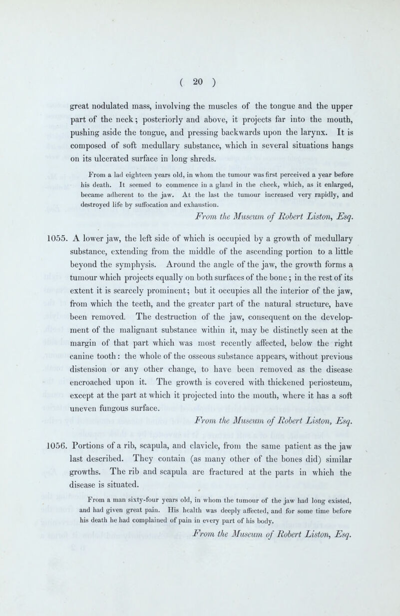 great nodulated mass, involving the muscles of the tongue and the upper part of the neck; posteriorly and above, it projects far into the mouth, pushing aside the tongue, and pressing backwards upon the larynx. It is composed of soft medullary substance, which in several situations hangs on its ulcerated surface in long shreds. From a lad eighteen years old, in whom the tumour was first perceived a year before his death. It seemed to commence in a gland in tiie cheek, which, as it enlarged, became adherent to the jaw. At the last the tumour increased very rapidly, and destroyed life by suffocation and exhaustion. From the Museum of Robert Liston, Esq. 1055. A lower jaw, the left side of which is occupied by a growth of medullary substance, extending from the middle of the ascending portion to a little beyond the symphysis. Around the angle of the jaw, the growth forms a tumour which projects equally on both surfaces of the bone; in the rest of its extent it is scarcely prominent; but it occupies all the interior of the jaw, from which the teeth, and the greater part of the natural structure, have been removed. The destruction of the jaw, consequent on the develop- ment of the malignant substance within it, may be distinctly seen at the margin of that part which was most recently affected, below the right canine tooth: the whole of the osseous substance appears, without previous distension or any other change, to have been removed as the disease encroached upon it. The growth is covered with thickened periosteum, except at the part at which it projected into the mouth, where it has a soft uneven fungous surface. From the Museum of Robert Liston, Esq. 1056. Portions of a rib, scapula, and clavicle, from the same patient as the jaw last described. They contain (as many other of the bones did) similar growths. The rib and scapula are fractured at the parts in which the disease is situated. From a man sixty-four years old, in whom the tumour of the jaw had long existed, and had given great pain. His health was deeply affected, and for some time before his death he had complained of pain in every part of his body. From the Museum of Robert Liston, Esq.