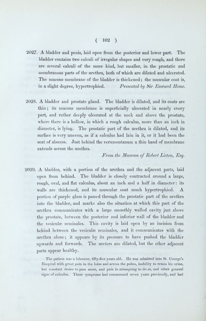 2027. A bladder and penis, laid open from the posterior and lower part. The bladder contains two calculi of irregular shapes and very rough, and there are several calculi of the same kind, but smaller, in the prostatic and membranous parts of the urethra, both of which are dilated and ulcerated. The mucous membrane of the bladder is thickened; the muscular coat is, in a slight degree, hypertrophied. Presented by Sir Everard Home. 2028. A bladder and prostate gland. The bladder is dilated, and its coats are thin; its mucous membrane is superficially ulcerated in nearly every part, and rather deeply ulcerated at the neck and above the prostate, where there is a hollow, in which a rough calculus, more than an inch in diameter, is lying. The prostatic part of the urethra is dilated, and its surface is very uneven, as if a calculus had lain in it, or it had been the seat of abscess. Just behind the verumontanum a thin band of membrane extends across the urethra. From the Museum of Robert Liston, Esq. 2029. A bladder, with a portion of the urethra and the adjacent parts, laid open from behind. The bladder is closely contracted around a large, rough, oval, and flat calculus, about an inch and a half in diameter: its walls are thickened, and its muscular coat much hypertrophied. A portion of purple glass is passed through the prostatic part of the urethra into the bladder, and marks also the situation at which this part of the urethra communicates with a large smoothly walled cavity just above the prostate, between the posterior and inferior wall of the bladder and the vesiculae seminales. This cavity is laid open by an incision from behind between the vesiculse seminales, and it communicates with the urethra alone; it appears by its pressure to have pushed the bladder upwards and forwards. The ureters are dilated, but the other adjacent parts appear healthy. Tlie patient was a labourer, fifty-five years old. He was admitted into St. George's Hospital with great pain in tlie loins and across the pubes, inability to retain his urine, but constant desire to pass more, and pain in attempting to do so, and other general signs of calculus. These symptoms had commenced seven years previously, and had