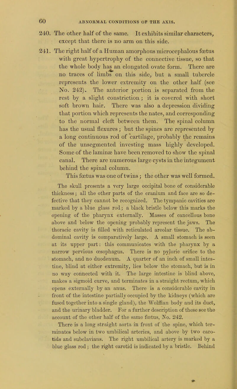2-10. The other half of the same. It exhibits similar characters, except that there is no arm on this side. 341. The right half of a Human amorphous microcephalous foetus with great hypertrophy of the connective tissue, so that the whole body has an elongated ovate form. There are no traces of limbs on this side, but a small tubercle represents the lower extremity on the other half (see No. 242). The anterior portion is separated from the rest by a slight constriction; it is covered with short soft brown hair. There was also a depression dividing that portion which represents the nates, and corresponding to the normal cleft between them. The spinal column has the usual flexures; but the spines are represented by a long continuous rod of cartilage, probably the remains of the unsegmented investing mass highly developed. Some of the laminae have been removed to show the spinal canal. There are numerous large cysts in the integument behind the spinal column. This foetus was one of twins; the other was well formed. The skull presents a very large occipital bone of considerable thickness; all the other parts of the cranium and face are so de- fective that they cannot be recognized. The tympanic cavities are marked by a blue glass rod; a black bristle below this marks the opening of the pharynx externally. Masses of cancellous bone above and below the opening probably represent tbe jaws. The thoracic cavity is filled with reticulated areolar tissue. The ab- dominal cavity is comparatively large. A small stomach is seen at its upper part: this communicates with the pharynx by a narrow pervious oesophagus. There is no pyloric orifice to the stomach, and no duodenum. A quarter of an inch of small intes- tine, blind at either extremity, lies below the stomach, but is in no way connected with it. The large intestine is blind above, makes a sigmoid curve, and terminates in a straight rectum, which opens externally by an anus. There is a considerable cavity in front of the intestine partially occupied by the kidneys (which are fused together into a single gland), the Wolffian body and its duct, and the uiinary bladder. For a further description of these see the account of the other half of the same foetus, No. 242. There is a long straight aorta in front of the spine, which ter- minates below in two umbilical arteries, and above by two caro- tids and subclavians. The right umbilical artery is marked by a blue glass rod; the right carotid is indicated by a bristle. Behind