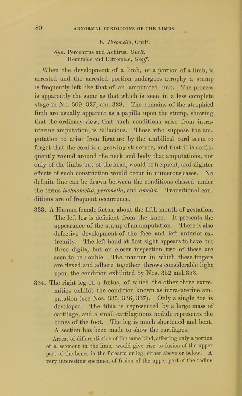 b. Peromelia, Gurlt. Syn. Perochirus and Achirus, Gurlt. Hemimele and Ectromele, Oeoff. When the development of a limb, or a portion of a limb, is arrested and the arrested portion undergoes atrophy a stump is frequently left like that of an amputated limb. The process is apparently the same as that which is seen in a less complete stage in No. 309, 327, and 328. The remains of the atrophied limb are usually apparent as a papilla upon the stump, showing that the ordinary view, that such conditions arise from intra- uterine amputation, is fallacious. Those who suppose the am- putation to arise from ligature by the umbilical cord seem to forget that the cord is a growing structure, and that it is so fre- quently wound around the neck and body that amputations, not only of the limbs hut of the head, would be frequent, and slighter effects of such constriction would occur in numerous cases. No definite line can be drawn between the conditions classed under the terms ischnomelia, peromelia, and amelia. Transitional con- ditions are of frequent occurrence. 333. A Human female foetus, about the fifth month of gestation. The left leg is deficient from the knee. It presents the appearance of the stump of an amputation. There is also defective development of the face and left anterior ex- tremity. The left hand at first sight appears to have but three digits, but on closer inspection two of these are seen to be double. The manner in which these fingers are flexed and adhere together throws considerable light upon the condition exhibited by Nos. 352 and, 353. 334. The right leg of a foetus, of which the other three extre- mities exhibit the condition known as intra-uterine am- putation (see Nos. 335, 336, 337). Only a single toe is developed. The tibia is represented by a large mass of cartilage, and a small cartilaginous nodule represents the bones of the foot. The leg is much shortened and bent. A section has been made to show the cartilages. Arrest of differentiation of the same kind, affecting only a portion of a segment in the limb, would give rise to fusion of the upper part of the bones in the forearm or leg, either above or below. A very interesting specimen of fusion of the upper part of the radius