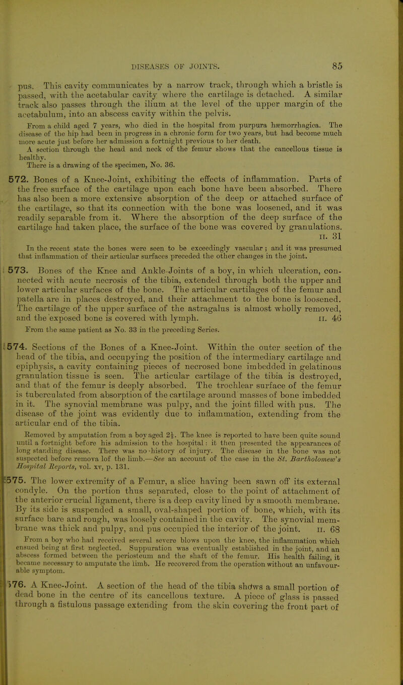 pus. This cavity communicates by a narrow track, tlirough which a bristle is passed, with the acetabular cavity where the cartilag-e is detached. A similar track also passes through the ilium at the level of the upper margin of the acetabulum, into an abscess cavity within, the pelvis. From a child aged 7 yeai's, who died in the hospital from purpura hsemorrhagica. The disease of the hip had been in progress in a chronic form for two years, but had become much more acute just before her admission a fortnight larevious to her death. A section through the head and neck of the femur shows that the cancellous tissue is healthy. There is a drawing of the specimen, No. 36. 572. Bones of a Knee-Joint, exhibiting the effects of inflammation. Parts of the free surface of the cartilage upon each bone have been absorbed. There has also been a more extensive absorption of the deep or attached surface of the cartilage, so that its connection with the bone was loosened, and it was readily separable from it. Where the absorption of the deep surface of the cartilage had taken place, the surface of the bone was covered by granulations. IT. 31 In the recent state the bones were seen to be exceedingly vascular ; and it was presumed that inflammation of their ai'ticular surfaces preceded the other changes in the joint. ' 573. Bones of the Knee and Ankle Joints of a boy, in which ulceration, con- nected with acute necrosis of the tibia, extended through both the upper and lower articular surfaces of the bone. The articular cartilages of the femur and patella are in places destroyed, and their attachment to the bone is loosened. The cartilage of the upper surface of the astragalus is almost wholly removed, and the exposed bone is covered with lymph. ii. 46 From the same patient as No. 33 in the preceding Series. 574. Sections of the Bones of a Knee-Joint. Within the outer section of the Lead of the tibia, and occupying the position of the intermediary cartilage and epiphysis, a cavity containing pieces of necrosed bone imbedded in gelatinous granulation tissue is seen. The articular cartilage of the tibia is destroyed, and that of the femur is deeply absorbed. The trochlear surface of the femur is tuberculated from absorption of the cartilage around masses of bone imbedded in it. The synovial membrane was pulpy, and the joint filled with pus. The disease of the joint was evidently due to inflammation, extending from the articular end of the tibia. Removed by amputation from a boy aged 2^. The knee is reported to have been quite sound until a fortnight before his admission to the hospital: it then presented the appearances of long standing disease. There was no -history of injury. The disease in the bone was not suspected before remova lof the limb.—See an account of the case in the St. Bartholomew's Koapital Reports, vol. xv, p. 131. 5575. The lower extremity of a Femur, a slice having been sawn off its external condyle. On the portion thus separated, close to the point of attachment of the anterior crucial ligament, there is a deep cavity lined by a smooth membrane. By its side is suspended a small, oval-shaped portion of bone, which, with its surface bare and rough, was loosely contained in the cavity. The synovial mem- brane was thick and pulpy, and pus occupied the interior of the joint. ii. 68 From a boy who had received several severe blows upon the knee, the inflammation which ensued being at first neglected. Suppuration was eventually established in the joint, and an abscess formed between the periosteum and the shaft of the femur. His health failing, it became necessary to amputate the limb. He recovered from the operation without an unfavour- able symptom, 576. A Knee-Joint. A section of the head of the tibia shdws a small portion of dead bone in the centre of its cancellous texture. A piece of glass is passed through a fistulous passage extending from the skin covering the front part of