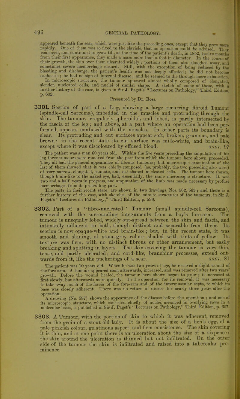 appeared beneath the scar, which were just like the preceding ones, except that they grew more rapidly. One of them was so fixed to the clavicle, tliat no operation could be advised. Thev coalesced, and continued to grow till, at the time of the patient's death, in 1852, twelve months from their first appearance, they made a mass more than a foot in diameter. In tlie course of their growth, the skin over them ulcerated widely ; portions of them also sloughed away, and sometimes severe hicmorrhage ensued. Still, with the exception of being reduced by the bleeding and discharge, the patient's health was not deeply affected; ho did not become cachectic ; he had no sign of internal disease; and he seemed to die tlirough mere exhaustion. In microscopic structure, the tumour appeared almost wholly composed of elongated, slender, nucleated cells, and nuclei of similar shape. A sketch of some of these, with a further history of the case, is given in Sir J. Paget's  Lectures on Pathology, Third Edition, p. 602. Presented by Dr. Eoss. 3301. Section of part of a Leg, sliov?ing a large recurring fibroid Tumour (spindle-cell Sarcoma), imbedded in the muscles and protruding through the skin. The tumour, irregularly spheroidal, and lobed, is partly intersected by the fascia of the leg; and above, at a part where an operation had been per- formed, appears confused with the muscles. In other parts its boundary is clear. Its protruding and cut surfaces appear soft, broken, grumous, and pale brown; in the recent state its cut surface was milk-white, and brain-like, except where it was discoloured by effused blood. xxxv. 97 The patient was a man 60 years old. Within the five years preceding the amputation of his leg three tumours were removed from the part from which the tumour here shown proceeded. They all had the general appearance of fibrous tumours; but microscopic examination of the last of them showed that it was chiefly composed (as, probably, the two preceding also were) of very narrow, elongated, caudate, and oat-shaped nucleated cells. The tumour here shown, though brain-like to the naked eye, had, essentially, the same microscopic sti-ucture. It was two and a-half years in progress, and amputation of the hmb was made necessary by profuse haemorrhages from its protruding part. The parts, in their recent state, are shown in two drawings, Nos. 562, 563 ; and there is a further history of the case, with sketches of the minute structures of the tumours, in Sir J. Paget's Lectures on Pathology, Third Edition, p. 598. 3302. Part of a fibro-nucleated Tumour (small spindle-cell Sarcoma), removed with the surrounding integuments from a boy's fore-arm. The tumour is unequally lobed, widely out-spread between the skin and fascia, and intimately adherent to both, though distinct and separable from them. Its section is now opaque-white and brain-like ; but, in the recent state, it was smooth and shining, of stone-grey colour shaded with tints of yellow. Its texture was firm, with no distinct fibrous or other arrangement, but easily breaking and splitting in layers. The skin covering the tumour is very thin, tense, and partly ulcerated ; and cord-like, branching processes, extend out- wards from it, like the puckerings of a scar. xxxv. 81 The patient was 10 years old. Wlien he was two years of age, he received a slight wound of the fore-arm. A tumour appeared soon afterwards, increased, and was removed after two years' growth. Before the wound healed, the tumour here shown began to grow ; it increased at first slowly, but afterwards more quickly. In the operation for its removal, it was necessary to take away much of the fascia of the fore-arm and of the intermuscular septa, to which its base was closely adherent. There was no return of disease for nearly three years after the operation. A drawing (No. 587) shows the appearance of the disease before the operation ; and one of its microscopic structure, which consisted chiefly of nuclei, arranged in overlying rows in a molecular basis, is published in Sir J. Paget's  Lectm-es on Pathology, Third Edition, p. 607, 3303. A Tumour, with the portion of skin to which it was adherent, removed from the groin of a stout old lady. It is about the size of a hen's egg, of a pale pinkish colour, gelatinous aspect, and firm consistence. The skin covering it is thin, and at one point there is an ulceration about the size of a sixpence : the skin around the ulceration is thinned but not infiltrated. On the outer side of the tumour the skin is infiltrated and raised into a tubercular pro- minence.