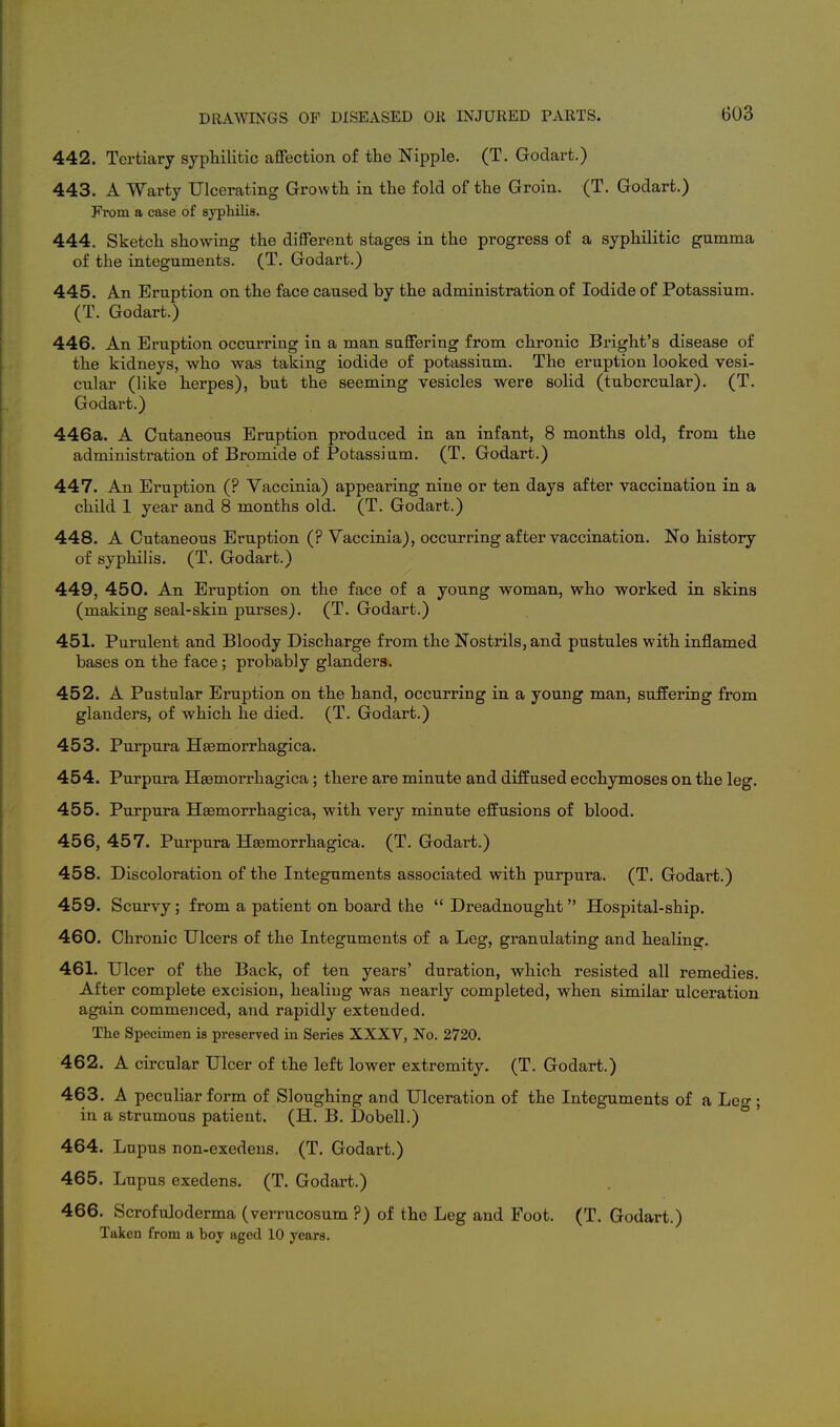 442. Tertiary syphilitic affection of the Nipple. (T. Goclart.) 443. A Warty Ulcerating Growth in the fold of the Groin. (T. Godart.) Fi-om a case of sypliilis. 444. Sketch showing the different stages in the progress of a syphilitic gumma of the integuments. (T. Godart.) 445. An Eruption on the face caused by the administration of Iodide of Potassium. (T. Godart.) 446. An Eruption occurring in a man suffering from chronic Bright's disease of the kidneys, who was taking iodide of potassium. The eruption looked vesi- cular (like herpes), but the seeming vesicles were solid (tubercular). (T. Godart.) 446a. A Cutaneous Eruption produced in an infant, 8 months old, from the administration of Bromide of Potassium. (T. Godart.) 447. An Eruption (? Yaccinia) appearing nine or ten days after vaccination in a child 1 year and 8 months old. (T. Godart.) 448. A Cutaneous Eruption (? Yaccinia), occurring after vaccination. No history of syphilis. (T. Godart.) 449. 450. An Eruption on the face of a young woman, who worked in skins (making seal-skin purses). (T. Godart.) 451. Purulent and Bloody Discharge from the Nostrils, and pustules with inflamed bases on the face; probably glanders. 452. A Pustular Eruption on the hand, occurring in a young man, suffering from glanders, of which he died. (T. Godart.) 453. Purpura Hsemorrhagica. 454. Purpura Hsemorrhagica; there are minute and diffused ecchymoses on the leg. 455. Purpura Hsemorrhagica, with very minute effusions of blood. 456. 457. Purpura Hgemorrhagica. (T. Godart.) 458. Discoloration of the Integuments associated with purpura. (T. Godart.) 459. Scurvy; from a patient on board the  Dreadnought Hospital-ship. 460. Chronic Ulcers of the Integuments of a Leg, granulating and healing. 461. Ulcer of the Back, of ten years' duration, which resisted all remedies. After complete excision, healiug was nearly completed, when similar ulceration again commenced, and rapidly extended. The Specimen is preserved in Series XXXV, No. 2720. 462. A circular Ulcer of the left lower extremity. (T. Godart.) 463. A peculiar form of Sloughing and Ulceration of the Integuments of a Leo-; in a strumous patient. (H. B. Dobell.) ° 464. Lupus non-exedens. (T. Godart.) 465. Lupus exedens. (T. Godart.) 466. Scrofuloderma (verrucosum ?) of the Leg and Foot. (T. Godart.) Taken from a boy aged 10 years.