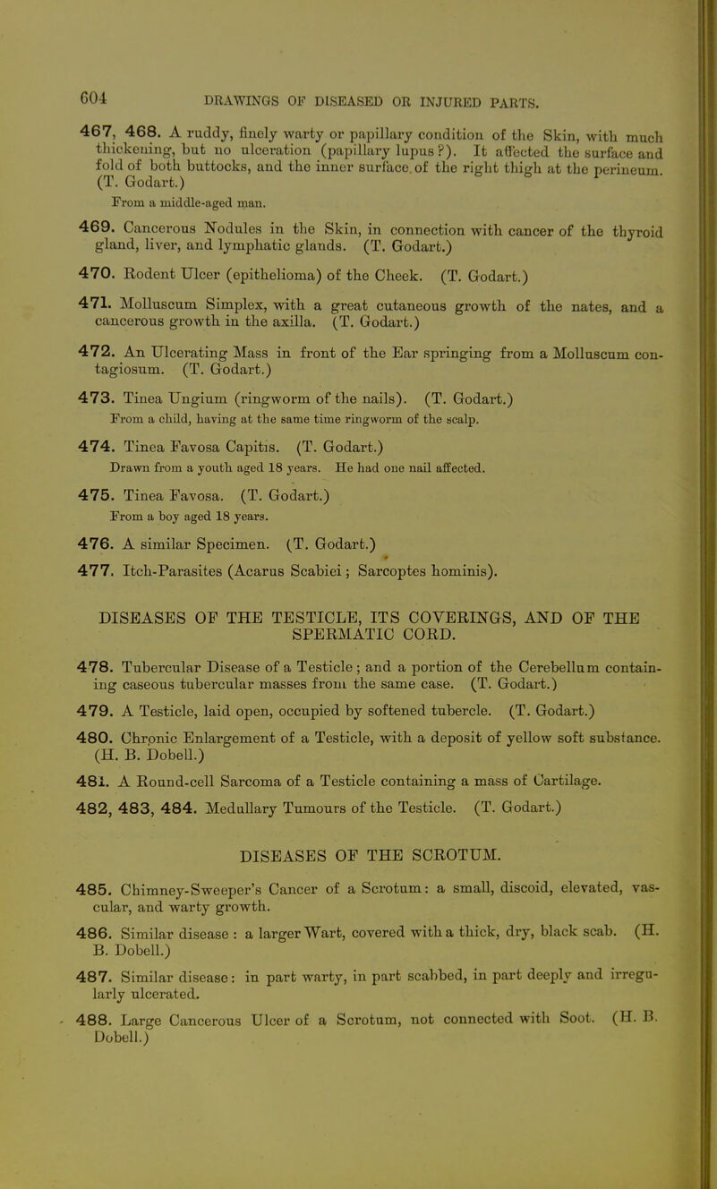 467, 468. A ruddy, finely warty or papillary condition of the Skin, with much thickening, but no ulceration (papillary lupus ?). It affected the surface and fold of both buttocks, and the inner surface, of the right thierh at the perineum (T. Godart.) b fa i • From a middle-aged man. 469. Cancerous Nodules in the Skin, in connection with cancer of the thyroid gland, liver, and lymphatic glands. (T. Godart.) 470. Rodent Ulcer (epithelioma) of the Cheek. (T. Godart.) 471. Molluscum Simplex, with a great cutaneous growth, of the nates, and a cancerous growth in the axilla. (T. Godart.) 472. An Ulcerating Mass in front of the Bar springing from a Molluscum con- tagiosum. (T. Godart.) 473. Tinea Ungium (ringworm of the nails). (T. Godart.) From a child, haying at the same time ringworm of the scalp. 474. Tinea Favosa Capitis. (T. Godart.) Drawn from a youth aged 18 years. He had one nail affected. 475. Tinea Favosa. (T. Godart.) From a boy aged 18 years. 476. A similar Specimen. (T. Godart.) 477. Itch-Parasites (Acarus Scabiei ; Sarcoptes hominis). DISEASES OF THE TESTICLE, ITS COVERINGS, AND OF THE SPERMATIC CORD. 478. Tubercular Disease of a Testicle; and a portion of the Cerebellum contain- ing caseous tubercular masses from the same case. (T. Godart.) 479. A Testicle, laid open, occupied by softened tubercle. (T. Godart.) 480. Chronic Enlargement of a Testicle, with, a deposit of yellow soft substance. (H. B. bobell.) 481. A Round-cell Sarcoma of a Testicle containing a mass of Cartilage. 482. 483, 484. Medullary Tumours of the Testicle. (T. Godart.) DISEASES OF THE SCROTUM. 485. Chimney-Sweeper's Cancer of a Scrotum: a smaU, discoid, elevated, vas- cular, and warty growth. 486. Similar disease : a larger Wart, covered with a thick, dry, black scab. (H. B. Dobell.) 487. Similar disease: in part warty, in part scabbed, in part deeply and irregu- larly ulcerated. 488. Large Cancerous Ulcer of a Scrotum, not connected with Soot. (H. B. Dobell.)