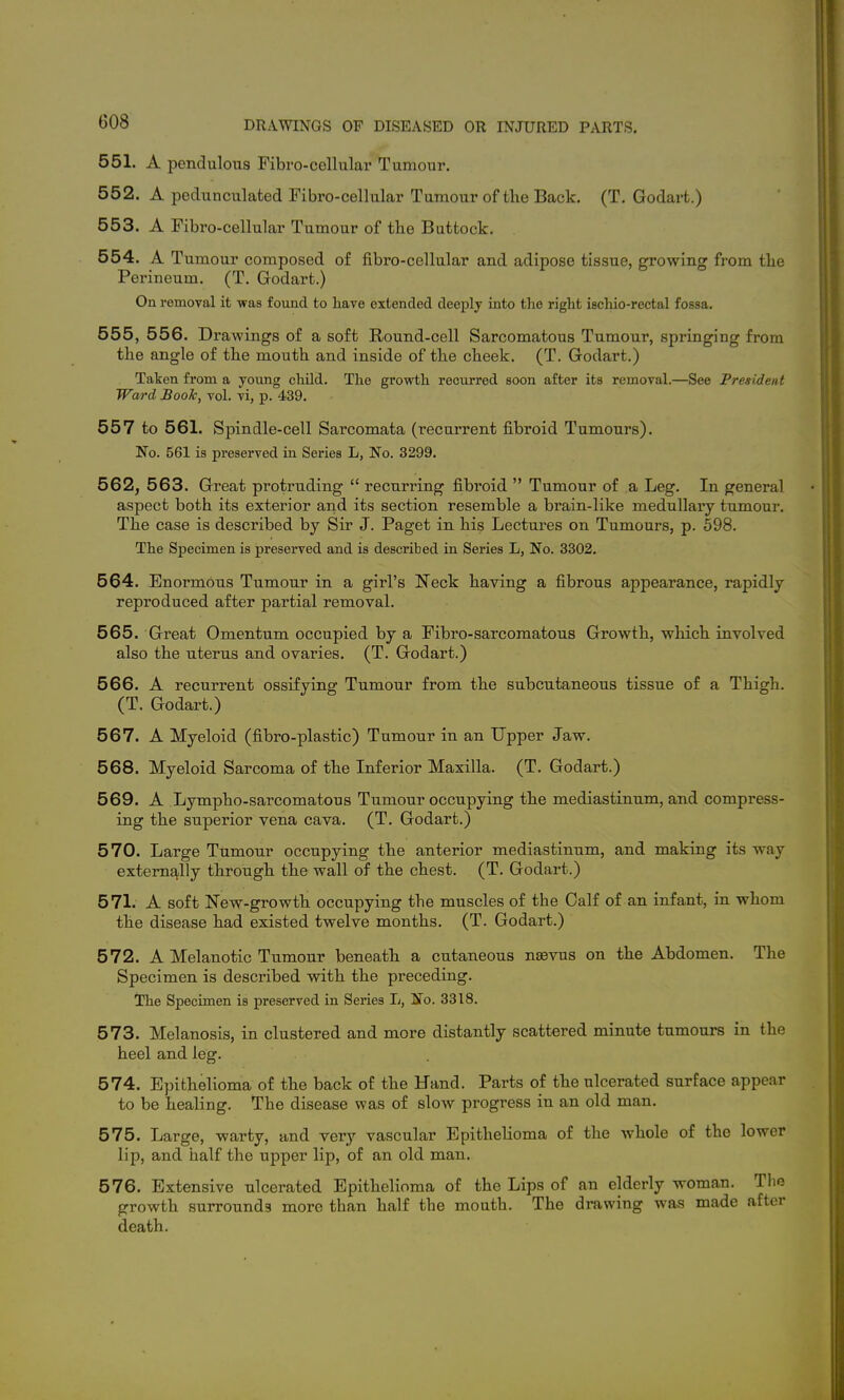 551. A pendulous Fibro-cellular Tumour. 552. A pedunculated Fibro-cellular Tumour of the Back. (T. Godart.) 553. A Fibro-cellular Tumour of the Buttock. 554. A Tumour composed of fibro-cellular and adipose tissue, growing from the Perineum. (T. Godart.) On removal it was found to have extended deeply into the right iechio-rectal fossa. 555. 556. D rawings of a soft Round-cell Sarcomatous Tumour, springing from the angle of the mouth and inside of the cheek. (T. Godart.) Talcen from a young child. The growth recurred soon after its removal.—See President Ward Book, vol. vi, p. 439. 557 to 561. Spindle-cell Sarcomata (recurrent fibroid Tumours). ISo. 561 is preserved in Series L, No. 3299. 562, 563. Great protruding  recurring fibroid  Tumour of a Leg. In general aspect both its exterior and its section resemble a brain-like medullary tumour. The case is described by Sir J. Paget in his Lectures on Tumours, p. 598. The Specimen is preserved and is described in Series L, No. 3302. 564. Enormous Tumour in a girl's I^eck having a fibrous appearance, rapidly reproduced after partial removal. 565. Great Omentum occupied by a Fibro-sarcomatous Growth, wliich involved also the uterus and ovaries. (T. Godart.) 566. A recurrent ossifying Tumour from the subcutaneous tissue of a Thigh. (T. Godart.) 567. A Myeloid (fibro-plastic) Tumour in an Upper Jaw. 568. Myeloid Sarcoma of the Inferior Maxilla. (T. Godart.) 569. A Lympho-sarcomatous Tumour occupying the mediastinum, and compress- ing the superior vena cava. (T. Godart.) 570. Large Tumour occupying the anterior mediastinum, and making its way externally through the wall of the chest. (T. Godart.) 571. A soft New-growth occupying the muscles of the Calf of an infant, in whom the disease had existed twelve months. (T. Godart.) 572. A Melanotic Tumour beneath a cutaneous nsevus on the Abdomen. The Specimen is described with the preceding. The Specimen is preserved in Series L, No. 3318. 573. Melanosis, in clustered and more distantly scattered minute tumours in the heel and leg. 574. Epithelioma of the back of the Hand. Parts of the ulcerated surface appear to be healing. The disease was of slow progress in an old man. 575. Large, warty, and very vascular Epithelioma of the whole of the lower lip, and half the upper lip, of an old man. 576. Extensive nlcerated Epithelioma of the Lips of an elderly woman. Tlie growth surrounds more than half the mouth. The drawing was made after death.