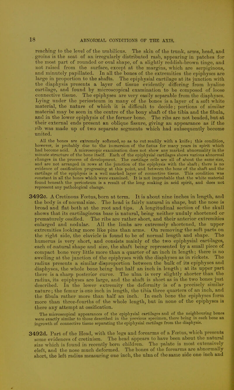 reaching to the level of the umbilicus. The skin of the trunk, arms, head, and groins is the seat of an irregularly distributed rash, appearing in patches for the most part of rounded or oval shape, of a slightly reddish-brown tinge, and not raised from the surface, except at the margins, which are serpiginous, and minutely papillated. In all the bones of the extremities the epiphyses are large in proportion to the shafts. The epiphysial cai'tilage at its junction with the diaphysis presents a layer of tissue evidently differing from hyaline cartilage, and found by microscopical examination to be composed of loose connective tissue. The epiphyses are very easily separable from the diaphyses. Lying under the periosteum in many of the bones is a layer of a soft white material, the nature of which it is difficult to decide; portions of similar material may be seen in the centre of the bony shaft of the tibia and the fibula, and in the lower epiphysis of the former bone. The ribs are not beaded, but at their external ends present an oblique fissure, giving an appearance as if the rib was made up of two separate segments which had subsequently become united. All the bones are extremely softened, so as to cut readily with a knife; this condition, however, is probably due to the immersion of the foetus for many years in spirit which had become acid. A microscopic examination does not show any marked abnormality in the minute structure of the bone itself. Each of the epiphysial cartilages shows various abnormal changes in the process of development. The cartilage cells are all of about the same size, and are not arranged in rows at the junction of the epiphysis with the shaft; there is no evidence of ossification progressing at this point, and between the bone of the shaft and the cartilage of the epiphysis is a well marked layer of connective tissue. This condition was constant in all the bones which were examined. It is not improbable that the white material found beneath the periosteum is a result of the long soaking in acid spirit, and does not represent any pathological change. 3492c. A Cretinous Foetus, born at term. It is about nine inches in length, and the body is of normal size. The head is fairly natural in shape, but the nose is broad and flat both at the root and tips. A longitudinal section of the skull shows that its cartilaginous base is natural, being neither unduly shortened or prematurely ossified. The ribs are rather short, and their anterior extremities enlarged and nodular. All the limbs are extremely shortened, the upper extremities looking more like pins than arms. On removing the soft parts on the right side, the clavicle is found to be of normal length and shape. The humerus is very short, and consists mainly of the two epiphysial cartilages, each of -natural shape and size, the shaft being represented by a small piece of compact bone very little more than a quarter of an inch in length; there is no swelling at the junction of the epiphyses with the diaphyses as in rickets. The radius presents a similar disproportion between the bulk of its epiphyses and diaphyses, the whole bone being but half an inch in length ; at its upper part there is a sharp posterior curve. The ulna is very slightly shorter than the radius, its epiphyses are large, and the shaft is short as in the two bones just described. In the lower extremity the deformity is of a precisely similar nature ; the femur is one inch in length, the tibia three quarters of an inch, and the fibula rather more than half an inch. In each bone the epiphyses form more than three-fourths of the whole length, but in none of the epiphyses is there any attempt at ossification. The microscopical appearances of the epiphysial cartilages and of the neighbouring bones were eiactly similar to those described in the previous specimen, there being in each bone an ingrowth of connective tissue separating the epiphysial cartilage from the diaphysis. 3492d. Part of the Head, with the legs and forearms of a Foetus, which presents some evidences of cretinism. The head appears to have been about the natural size which is found in recently born children. The palate is most extensively cleft, and the nose much deformed. The bones of the forearms are abnormally short, the left radius measuring one inch, the ulna of thesamo side one inch and