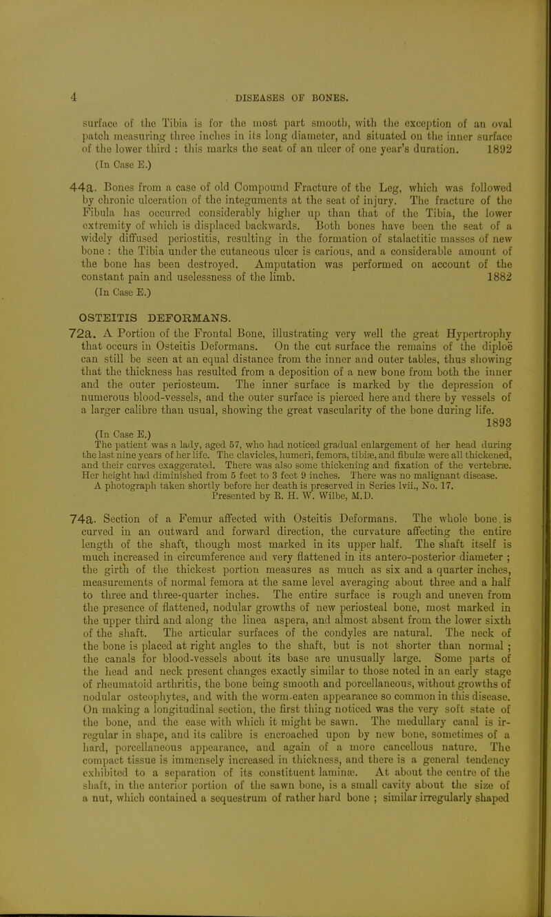 surt'aco of the Tibia is for tlio most part sinootli, with tlic exception of an oval patch measuring three inclies in its long diameter, and situated on the inner surface of the lower third : this marks the seat of an ulcer of one year's duration. 1892 (In Case E.) 44a. Bones from a case of old Compound Fracture of the Leg, which was followed by chronic ulceration of the integuments at the seat of injury. The fracture of the Fibula has occurred considerably higher up than that of the Tibia, the lower extremity of wliich is displaced backwards. Both bones have been the seat of a widely diffused periostitis, resulting in the formation of stalactitic masses of new bone : the Tibia under the cutaneous ulcer is carious, and a considerable amount of the bone has been destroyed. Amputation was performed on account of the constant pain and uselessness of the limb. 1882 (In Case E.) OSTEITIS DEFORMANS. 72a. A Portion of the Frontal Bone, illustrating very well the great Hypertrophy that occurs in Osteitis Deformans. On the cut surface the remains of the diploe can still be seen at an equal distance from the inner and outer tables, thus showing that the thickness has resulted from a deposition of a new bone from both the inner and the outer periosteum. The inner surface is marked by the depression of numerous blood-vessels, and the outer surface is pierced here and there by vessels of a larger calibre than usual, showing the great vascularity of the bone during life. 1893 (In Case E.) The patient was a lady, aged 57, who had noticed gradual enlargement of her head during the last nine years of her life. The clavicles, humeri, femora, tibiae, and fibulse were all thickened, and their curves exaggerated. There was also some thickening and fixation of the vcrtebrag. Her height had diminished from 5 feet to 3 feet 9 inches. 'J'here was no malignant disease. A photograph taken shortly before her death is preserved in Series Ivii., No. 17. Presented by R. H. W. Wilbe, M.D. 74a. Section of a Femur affected with Osteitis Deformans. The whole bone.is curved in an outward and forward direction, the curvature afifecting the entire length of the shaft, though most marked in its upper half. The shaft itself is much increased in circumference and very flattened in its antero-posterior diameter ; the girth of the thickest portion measures as much as six and a quarter inches, measurements of normal femora at the same level averaging about three and a half to three and three-quarter inches. The entire surface is rough and uneven from the presence of flattened, nodular growths of new periosteal bone, most marked in the upper third and along the linea aspera, and almost absent from the lower sixth of the shaft. The articular surfaces of the condyles are natural. The neck of the bone is placed at right angles to the shaft, but is not shorter than normal ; the canals for blood-vessels about its base are unusually large. Some parts of the head and neck present changes exactly similar to those noted in an early stage of rheumatoid arthritis, the bone being smooth and porcellaneous, without growths of nodular osteophytes, and with the worm-eaten appearance so common in this disease. On making a longitudinal section, the first thing noticed was the very soft state of the bone, and the ease with which it might be sawn. The medullary canal is ir- regular in shape, and its calibre is encroached upon by new bone, sometimes of a hard, porcellaneous appearance, and again of a more cancellous nature. The compact tissue is immensely increased in thickness, and there is a general tendency exhibited to a separation of its constituent lamina;. At about the centre of the shaft, in tlie anterior portion of the sawn bone, is a small cavity about the size of a nut, which contained a sequestrum of rather liard bone ; similar irregularly shaped I
